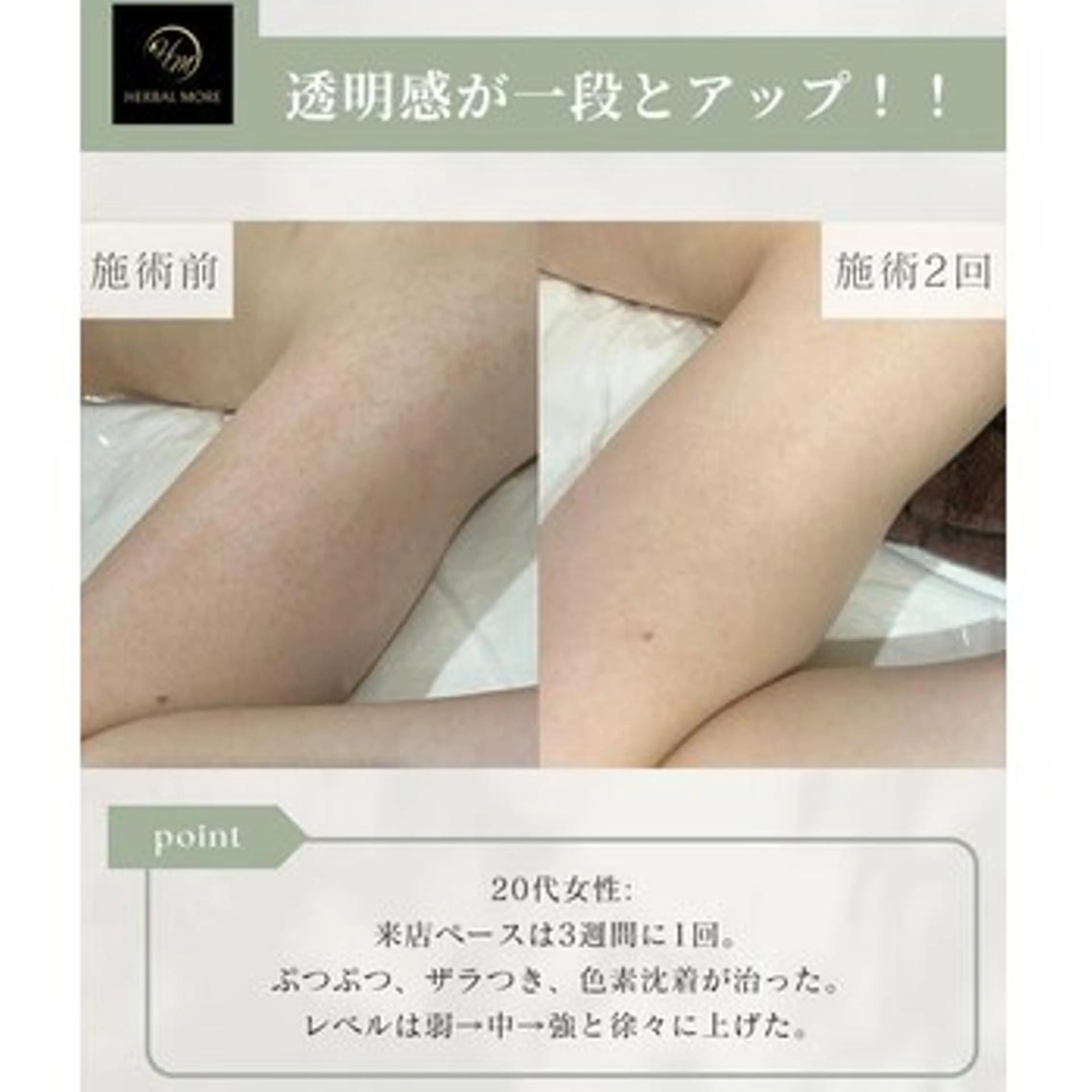【腕ケア】剥けるハーブピーリング＋鎮静パックの写真