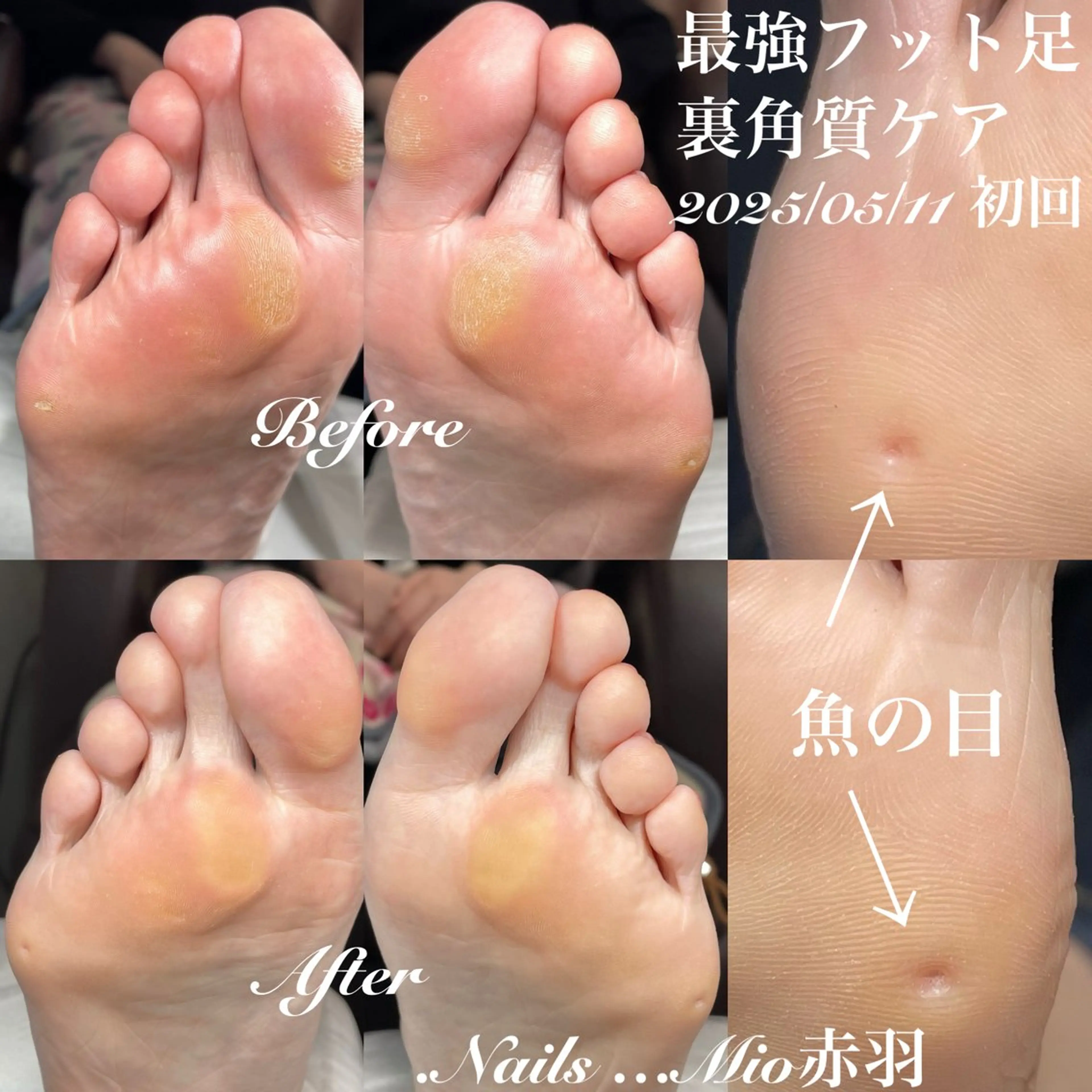 👣フットつらい魚の目、タコケア→1箇所の写真
