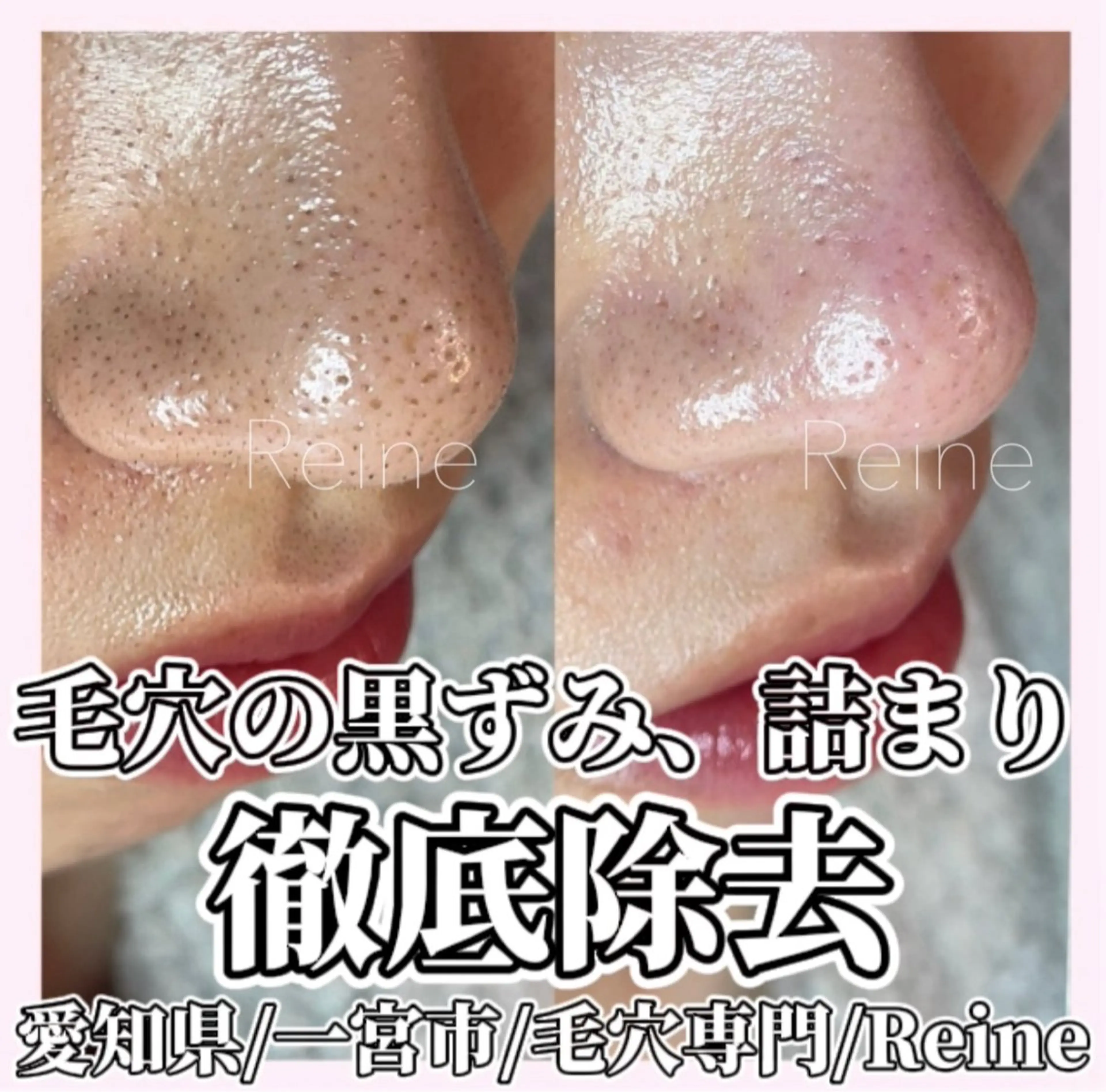 エステ Reine BeautySalon所属・毛穴/シミ肝斑/脱毛 横山梨里のエステ・リラクイメージ