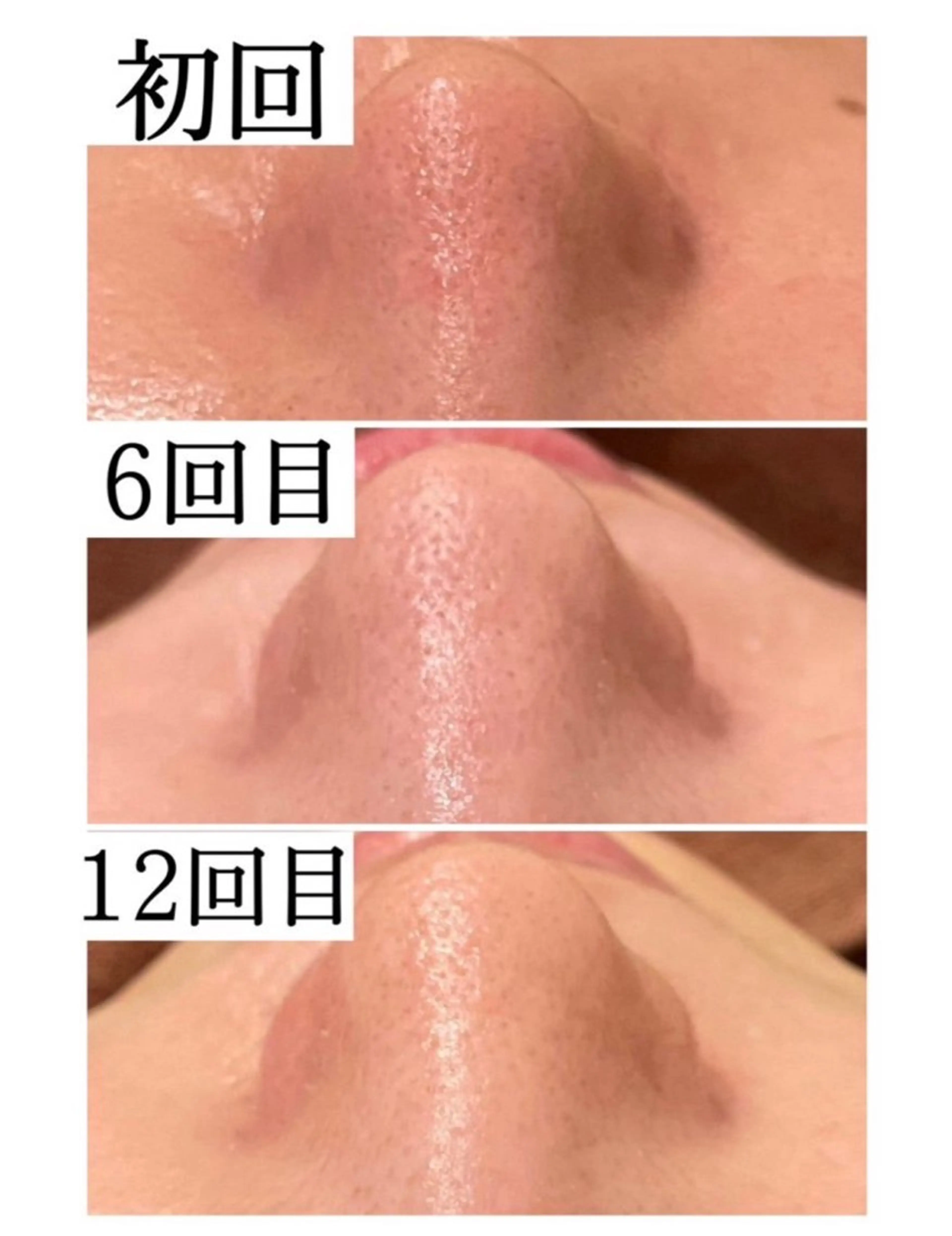 学生ニキビ改善🍀 優しい肌質改善のエステ・リラクイメージ