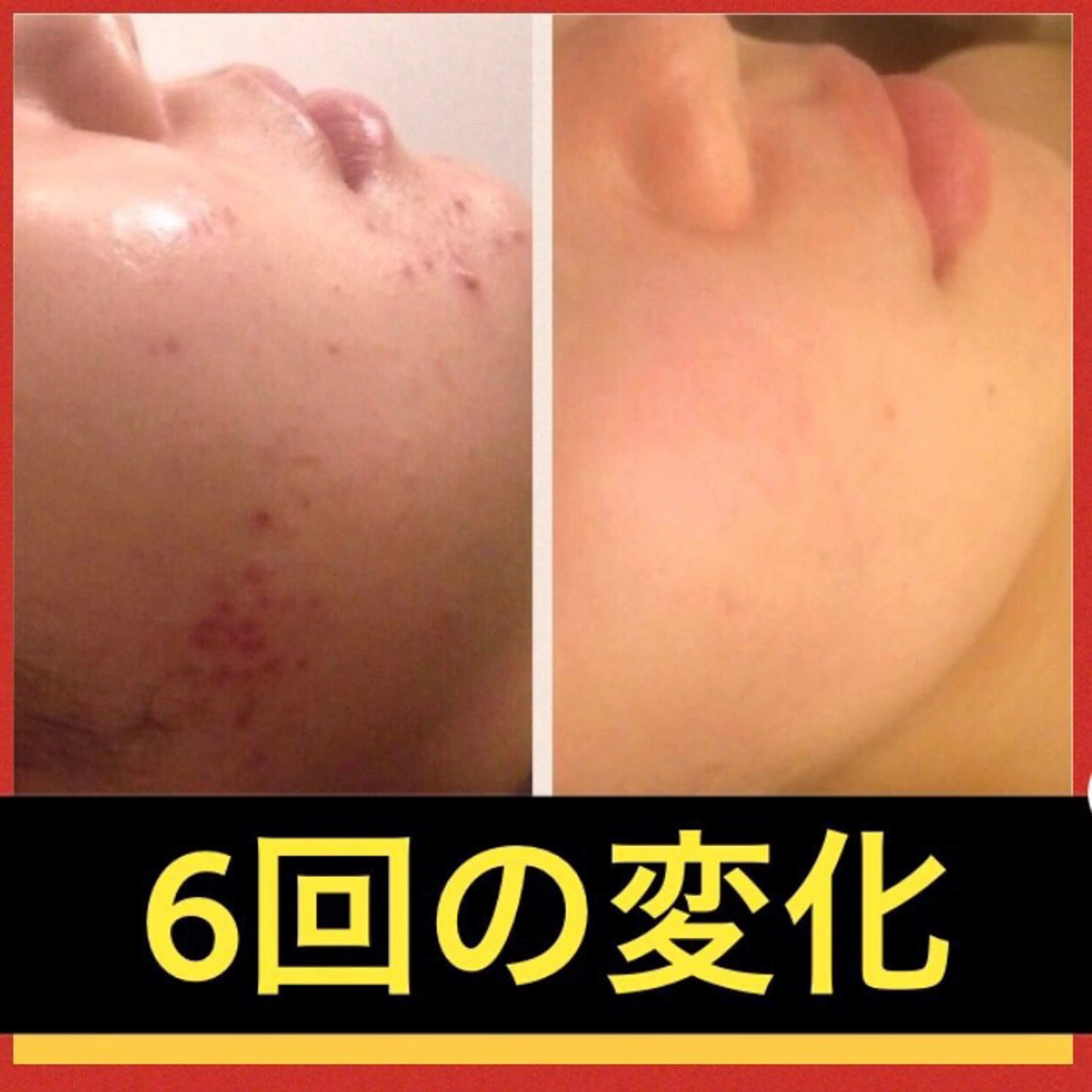 学生ニキビ改善🍀 優しい肌質改善のエステ・リラクイメージ