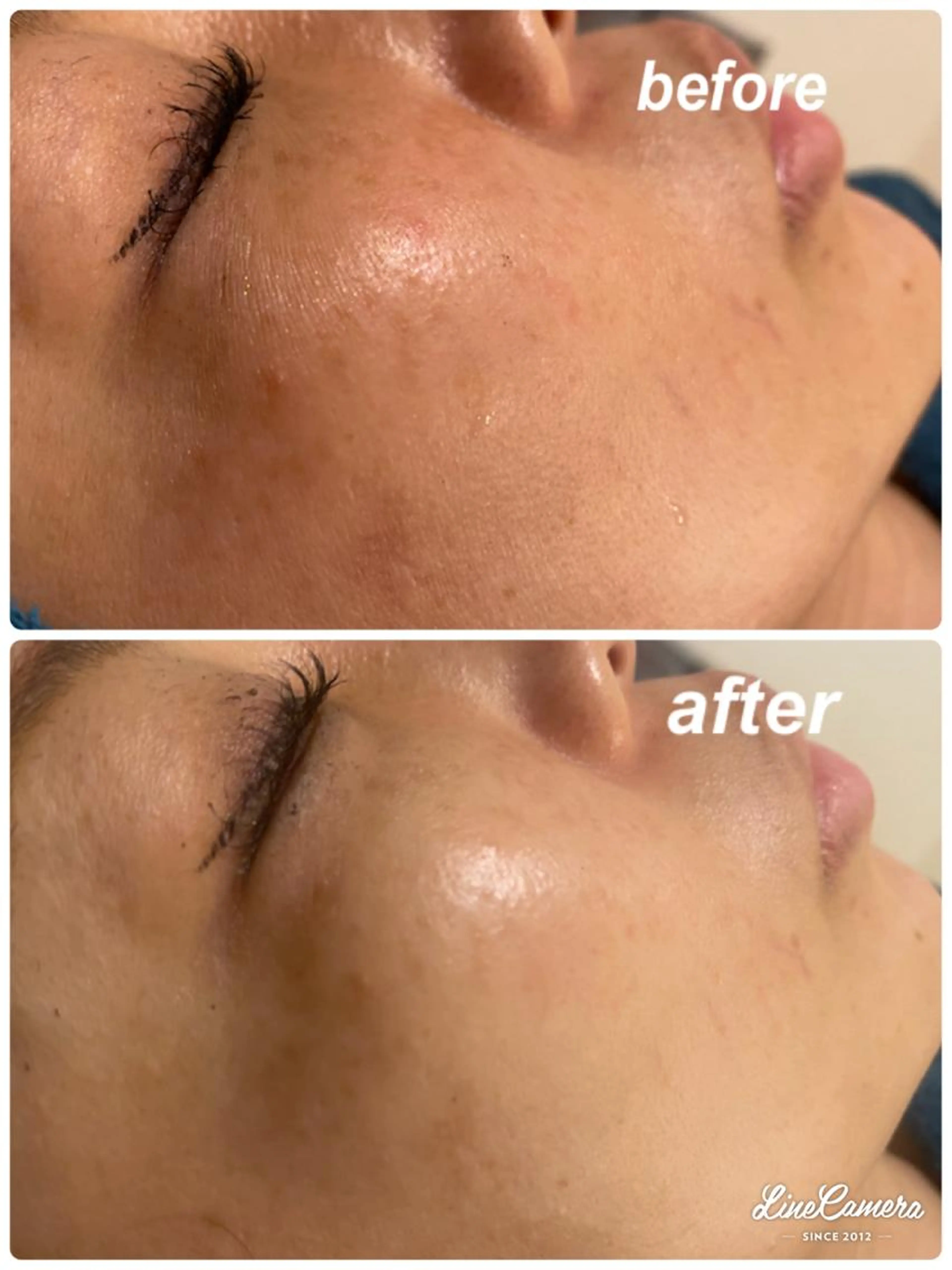 毛穴洗浄エステの写真