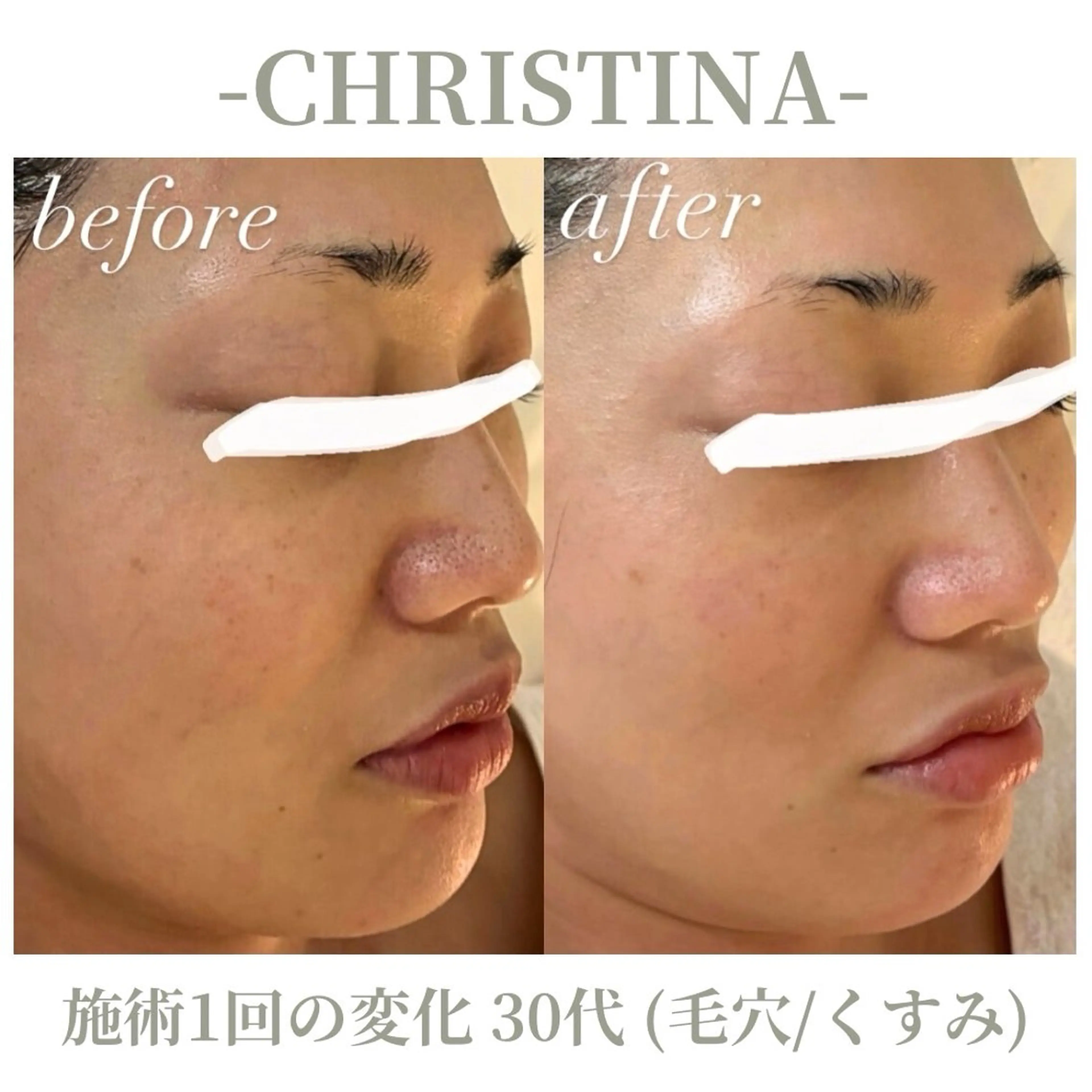 エステ 肌質改善|天王寺 For...はるかのエステ・リラクイメージ