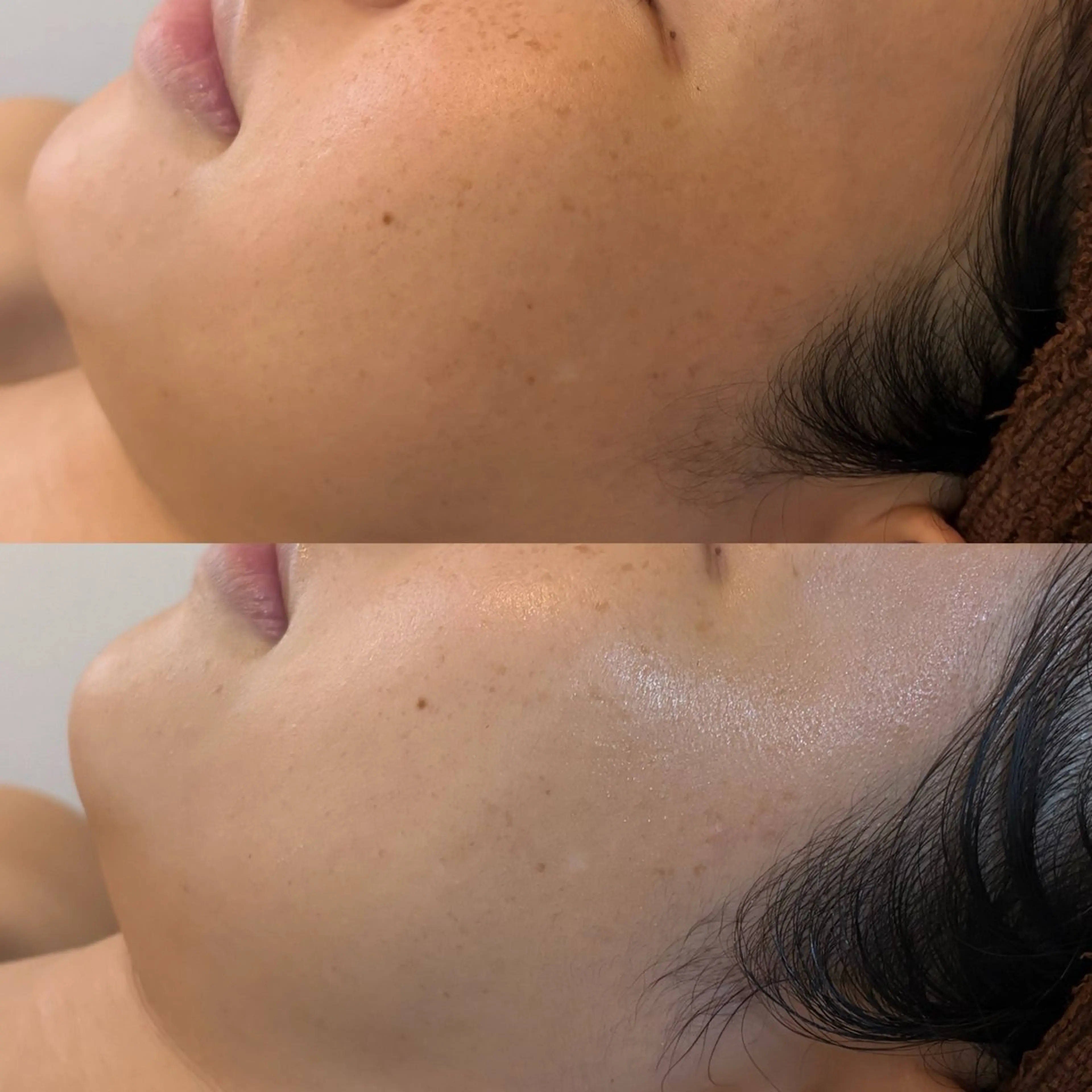 💆🏼‍♀️毛穴ケアフェイシャル30分(光ﾌｫﾄ＋ﾊﾟｯｸ) ¥2200の写真