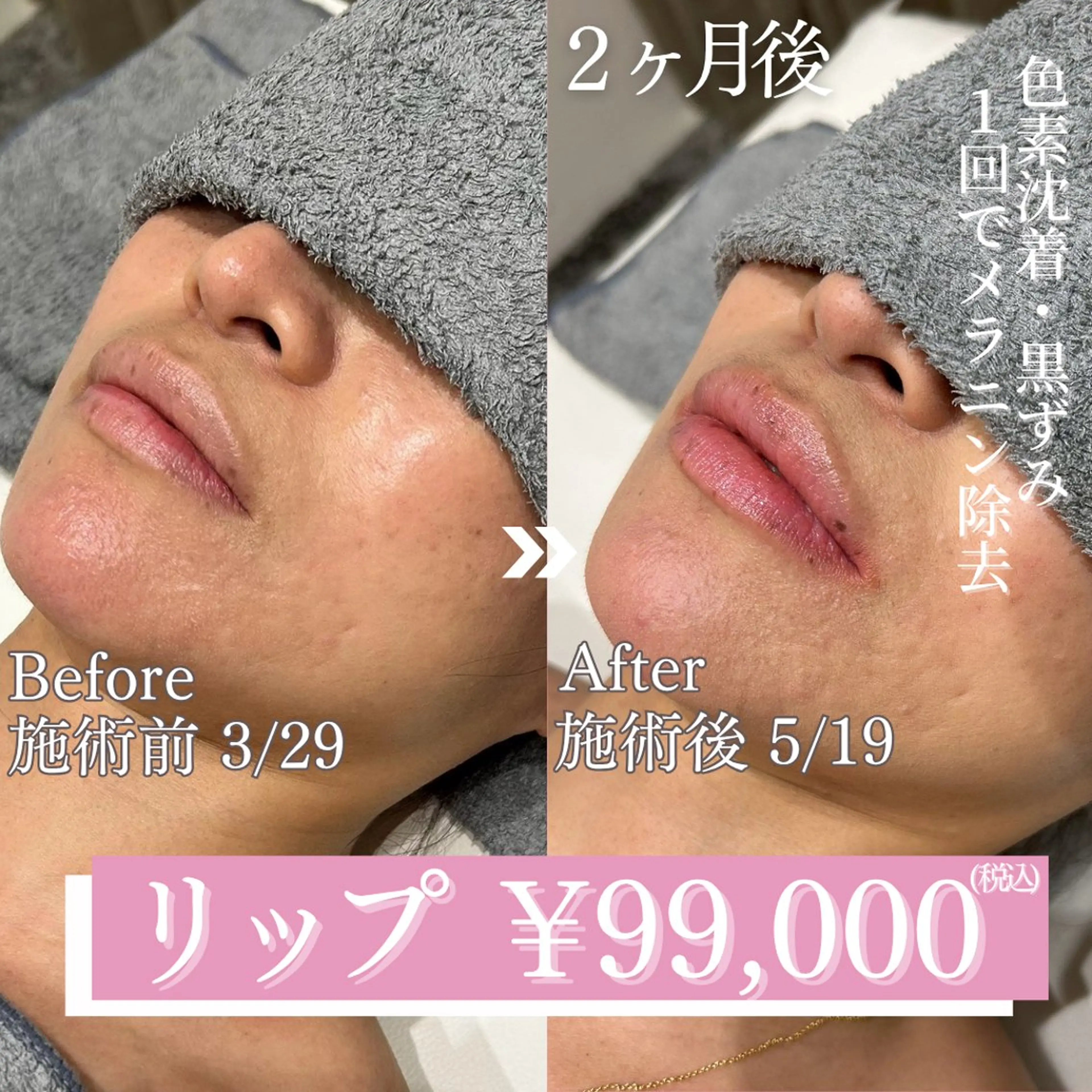 色素沈着・メラニン除去🫧ローマピンク【リップ】の写真