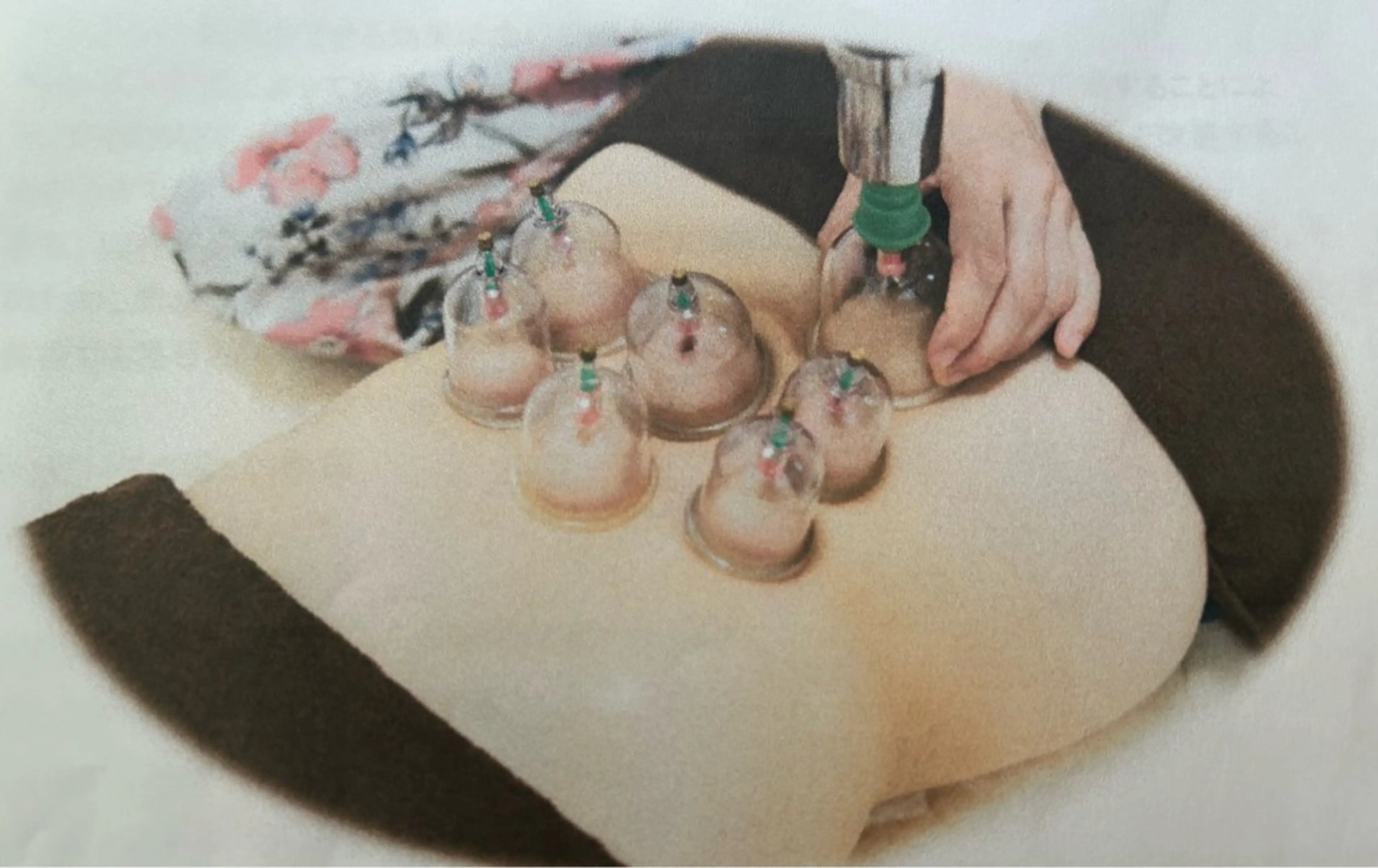 お腹カッピングで腸からデトックスの写真