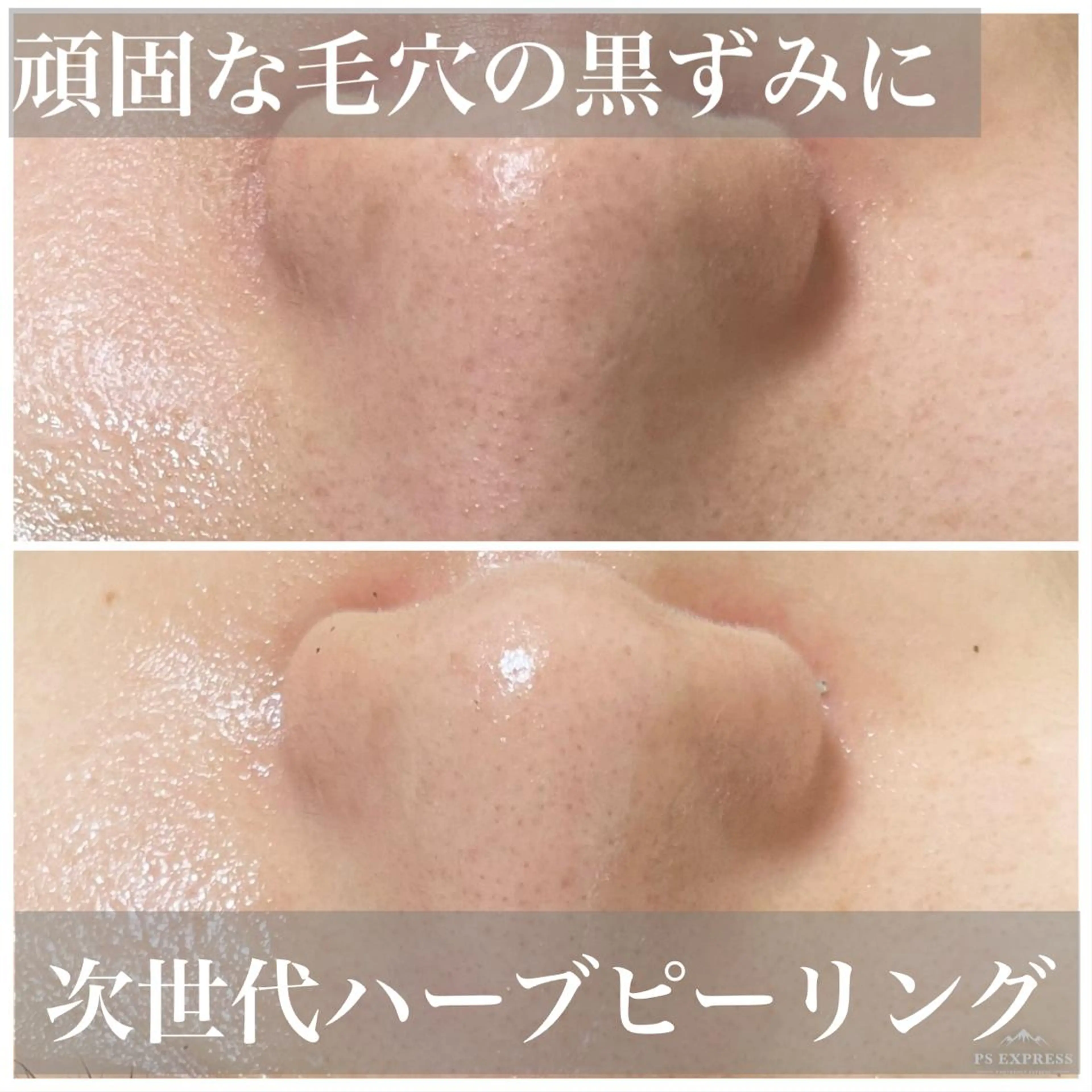 エステ ニキビ毛穴改善 🌿ハーブピーリングのエステ・リラクイメージ