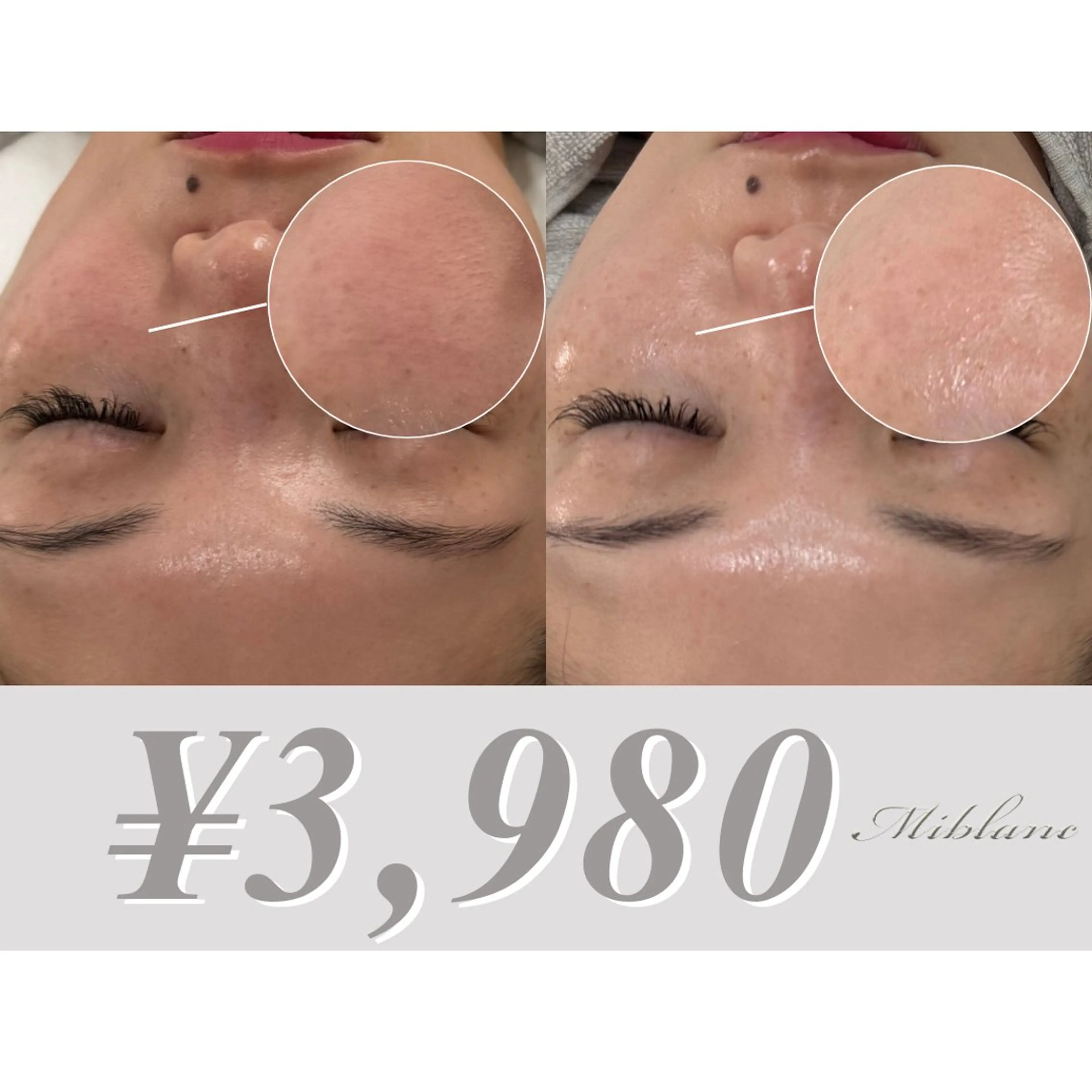 【モニター募集】《乾燥にお悩みの方》お肌ダメージ修復ケア🧖🏻‍♀️＊1日2名限定＊ 通常価格¥5,800→の写真