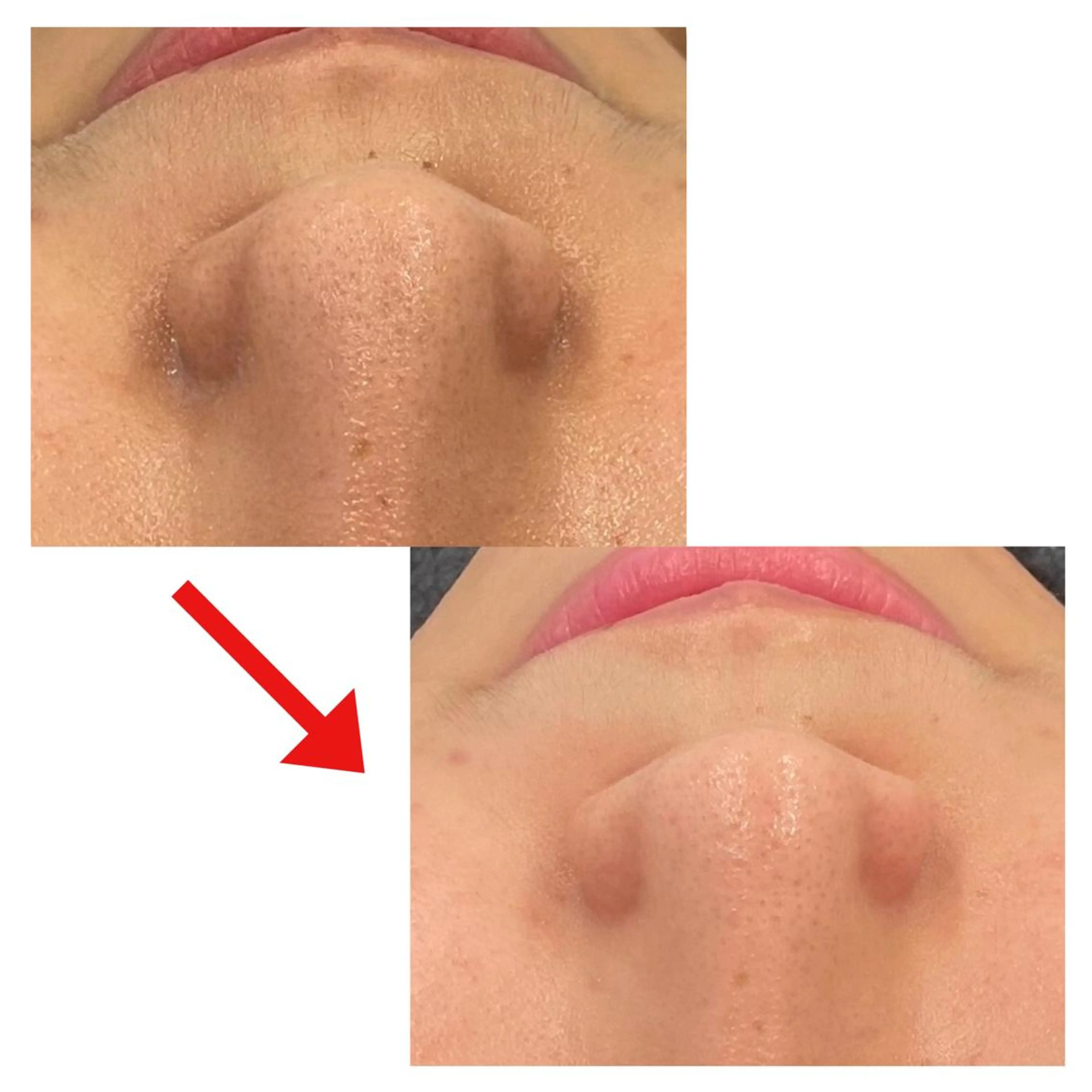 洗顔では落ちない汚れをスッキリ✨高濃度炭酸エステの写真