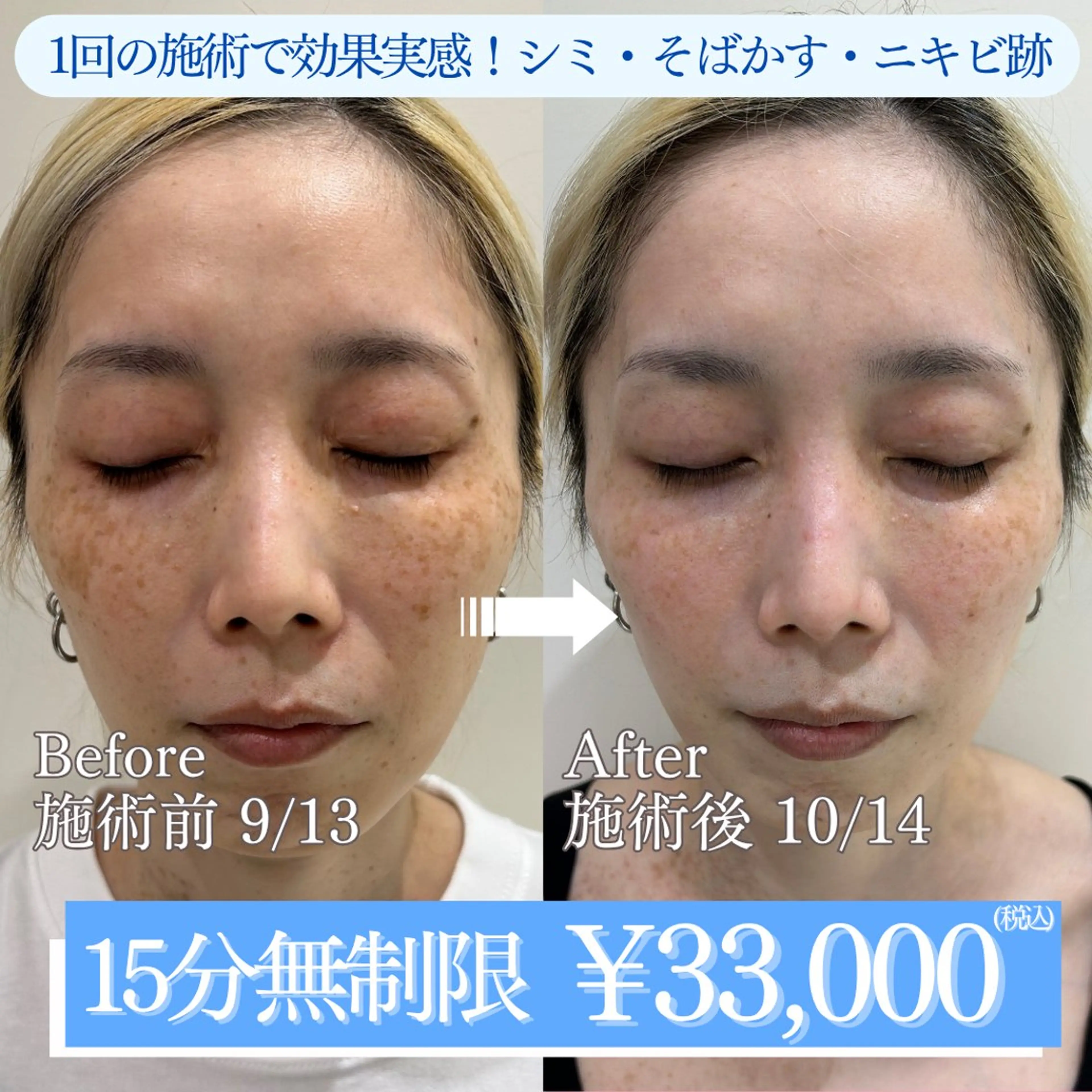 ホワイトラボ🫧シミ・ニキビ跡・色素沈着15分無制限で除去!の写真