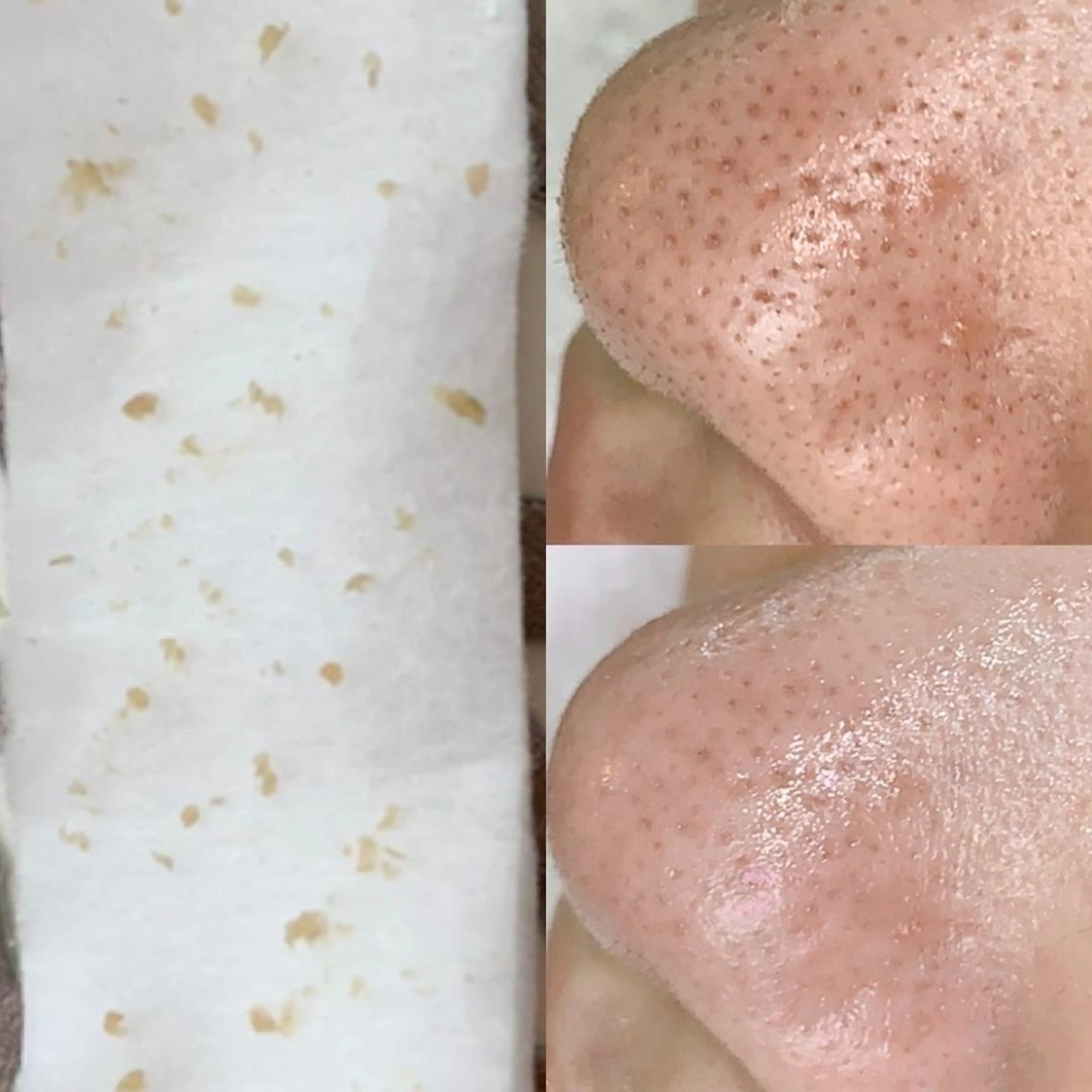 毛穴エクストラクションで毛穴の黒ずみ、詰まりが劇的改善!の写真