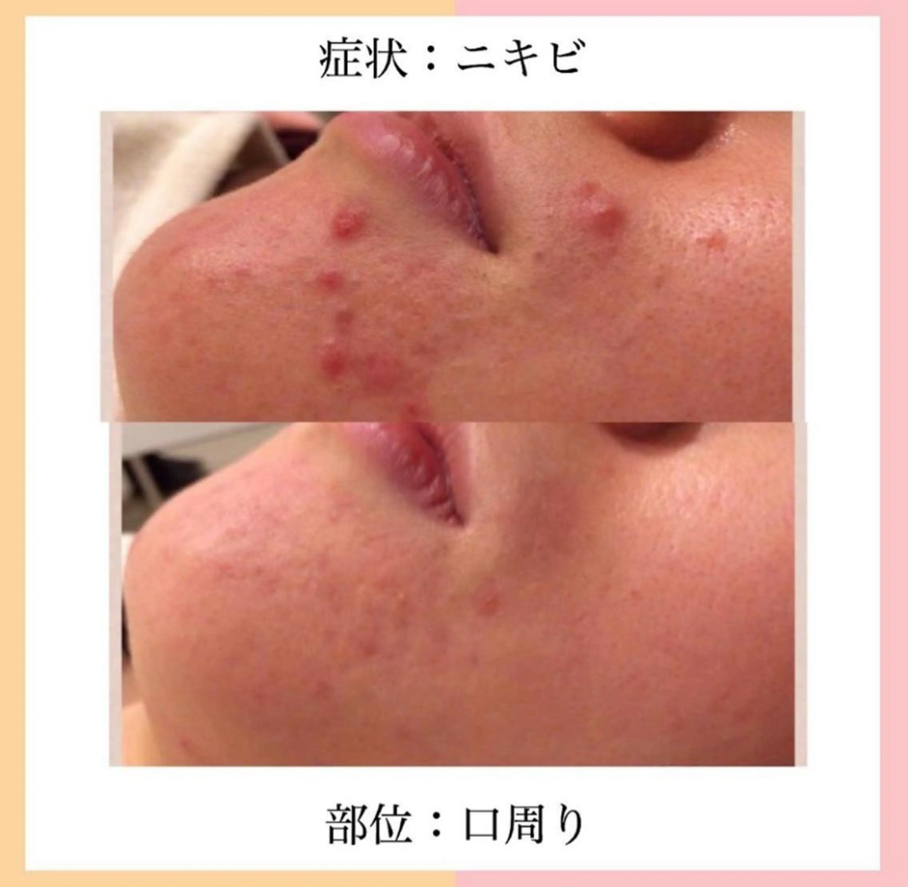 皮膚科より効果あり ⁉️最短ニキビ改善のエステ・リラクイメージ