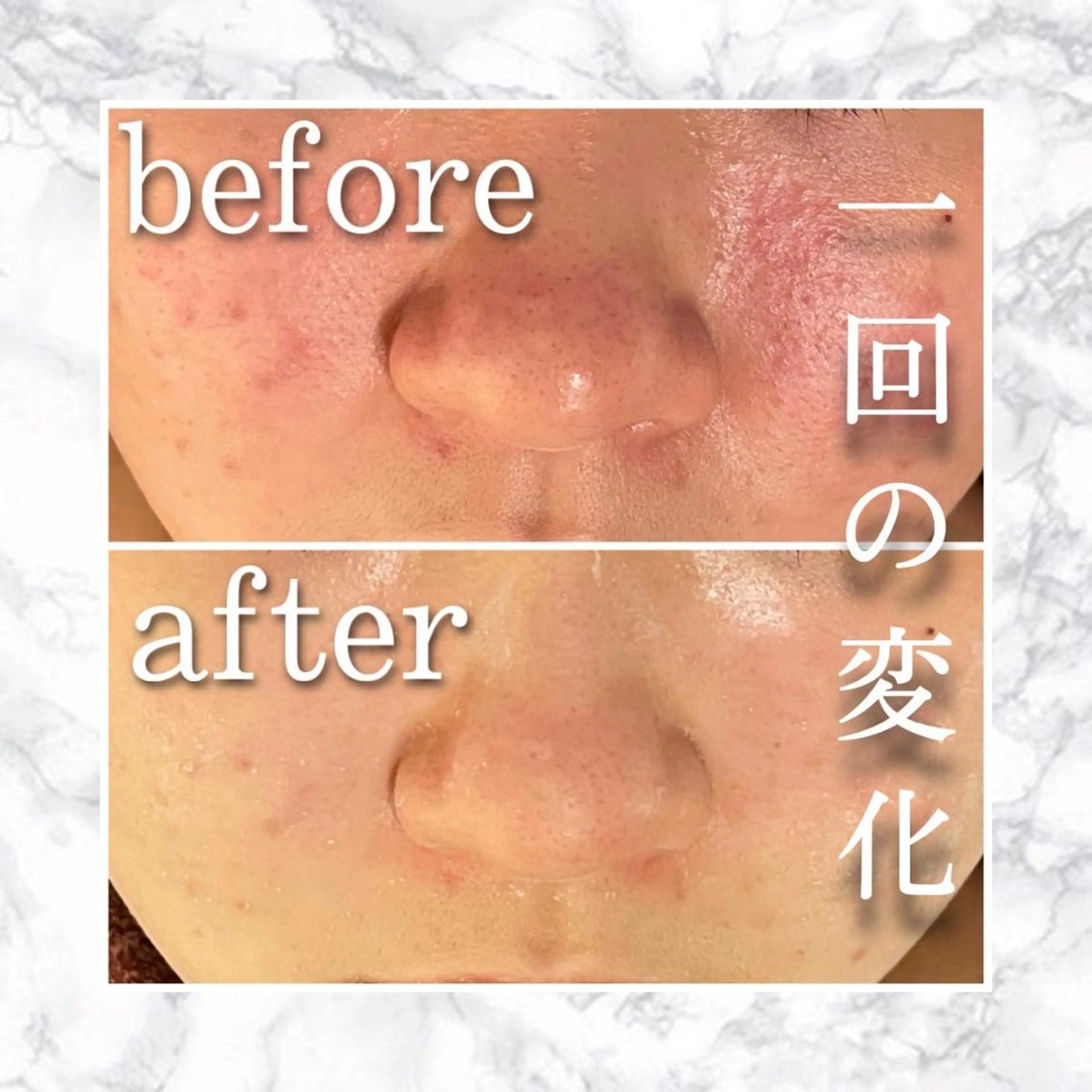 セミロング カラー パーマ ヘアアレンジ メンズ キッズ ネイル マツエク・マツパ アイブロウ エステ リラク ニキビ特化型エステ 🍋最短で肌質改善のエステ・リラクイメージ