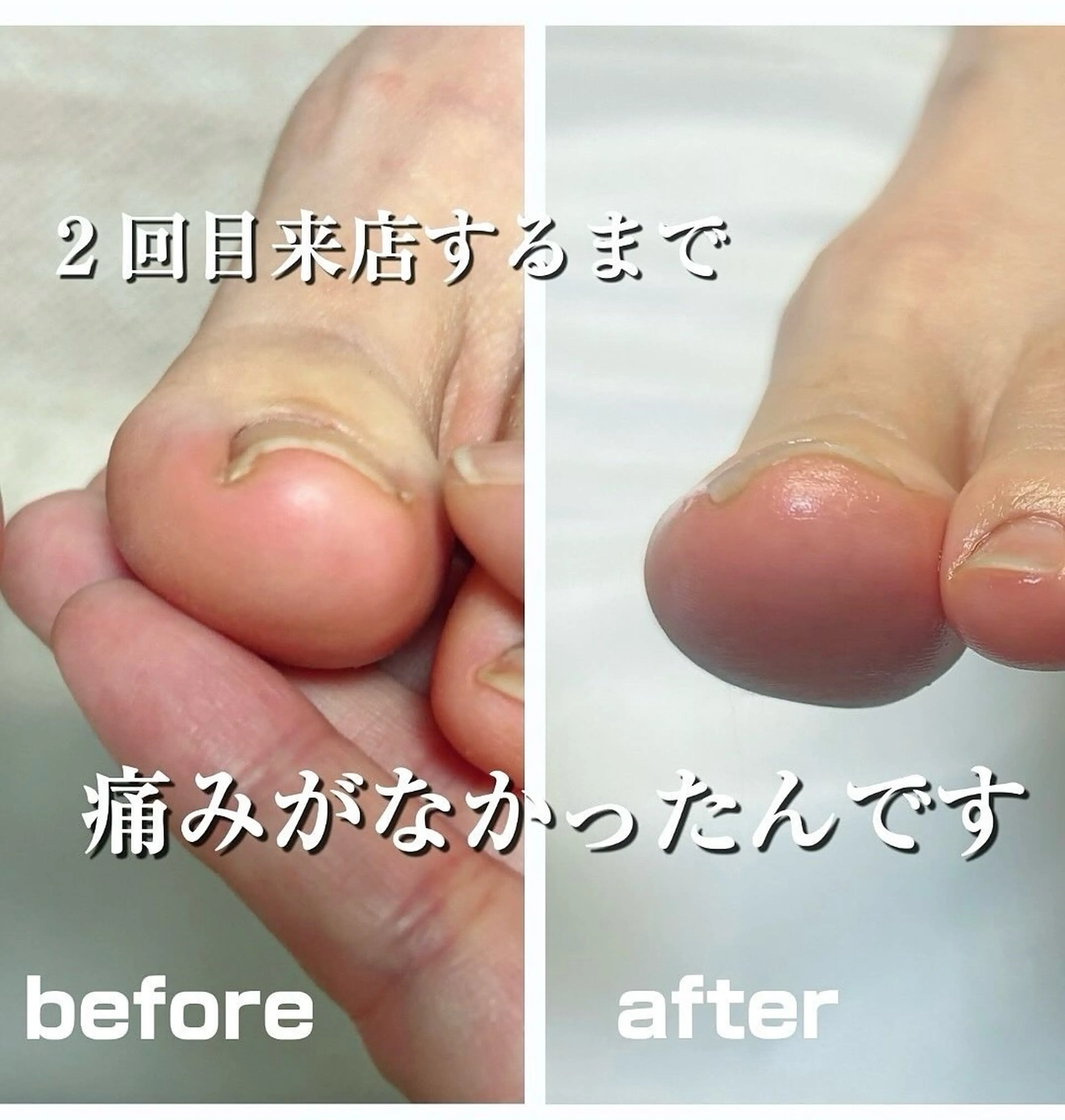 その他 巻き爪フットケアサロンKotori所属・フットケアサロン Kotoriのその他イメージ