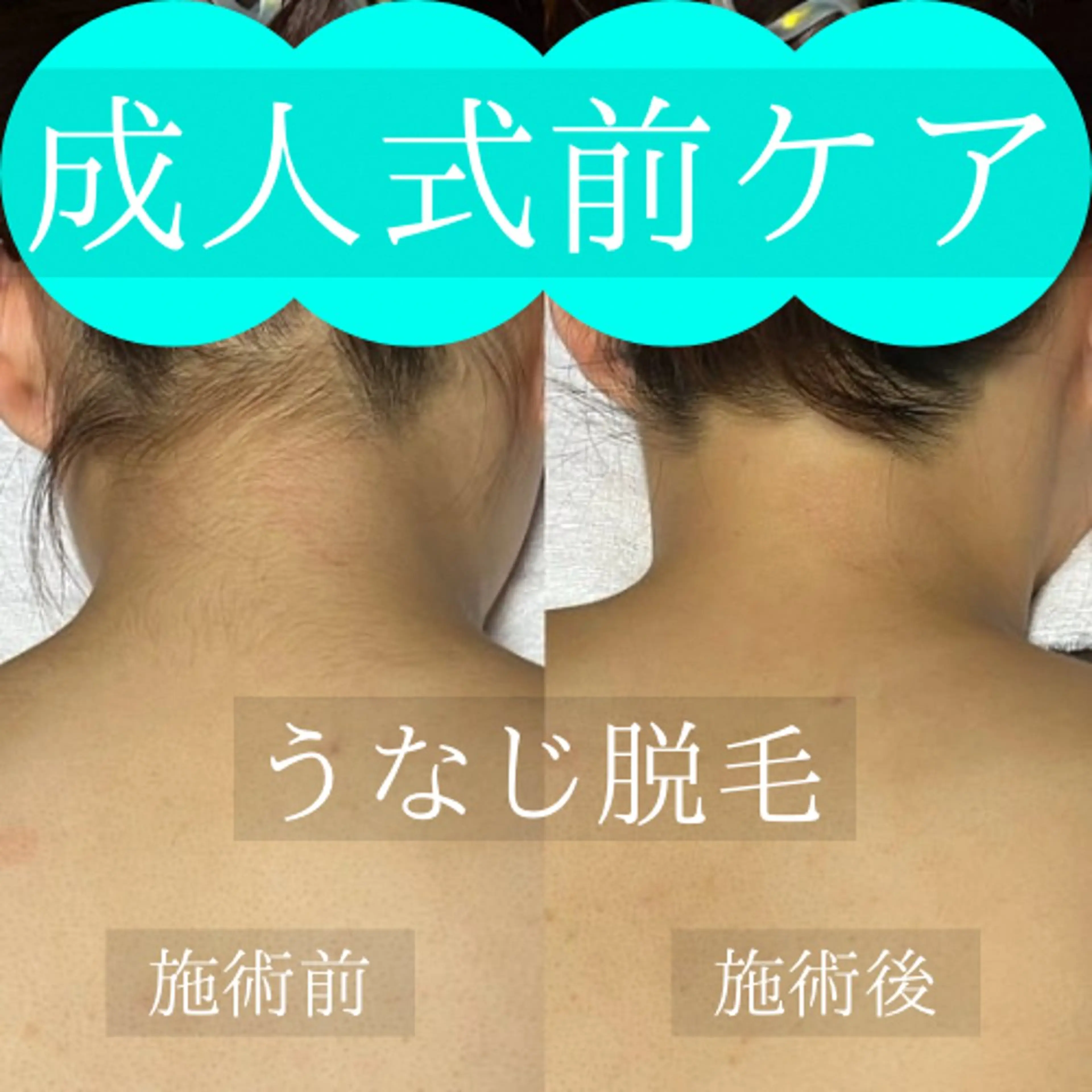 【成人式前ケア⭐︎】うなじ脱毛 ¥3,000✨の写真