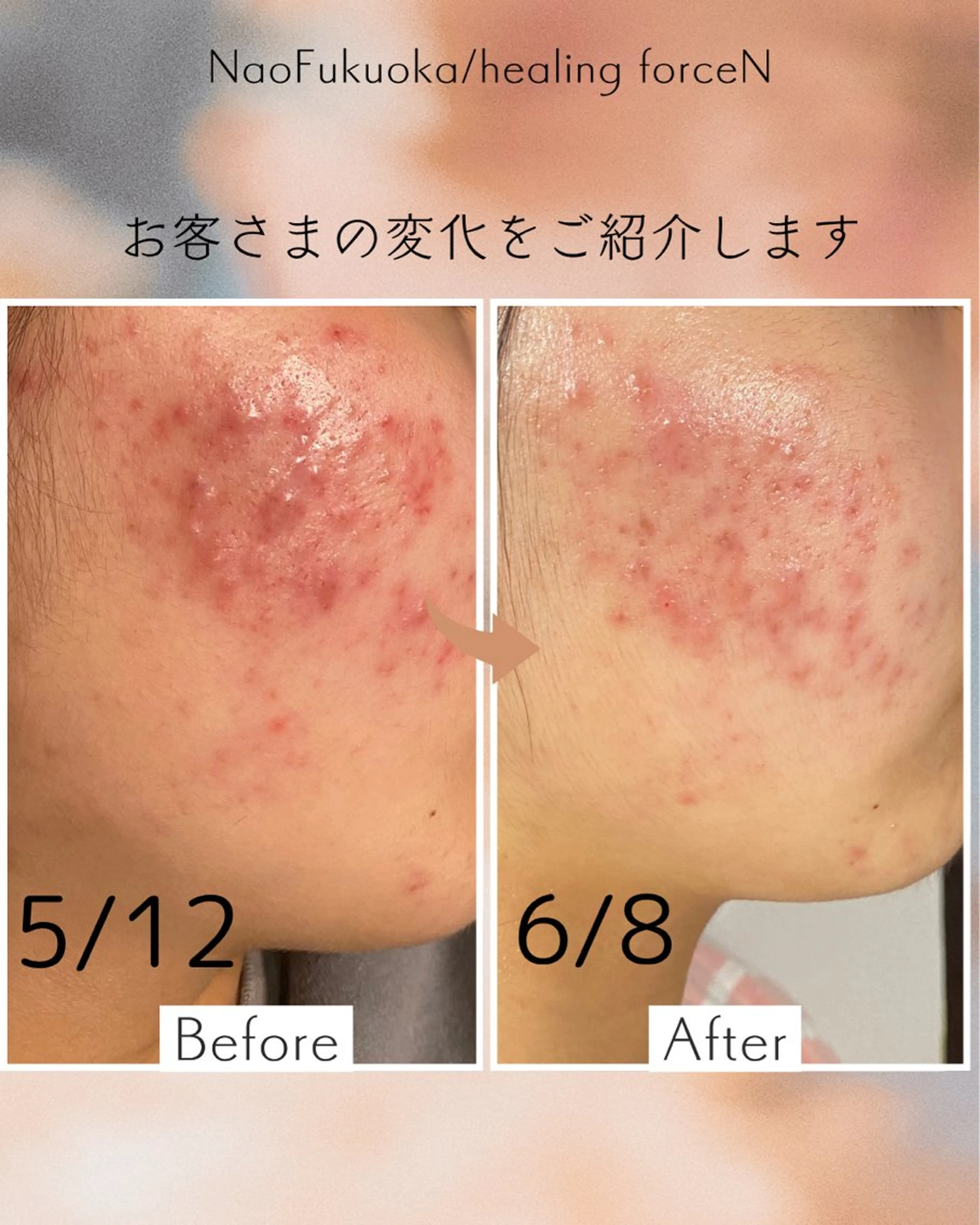 モニター募集💁♀️肌荒れケアハーブピーリングプログラム(6回)の写真