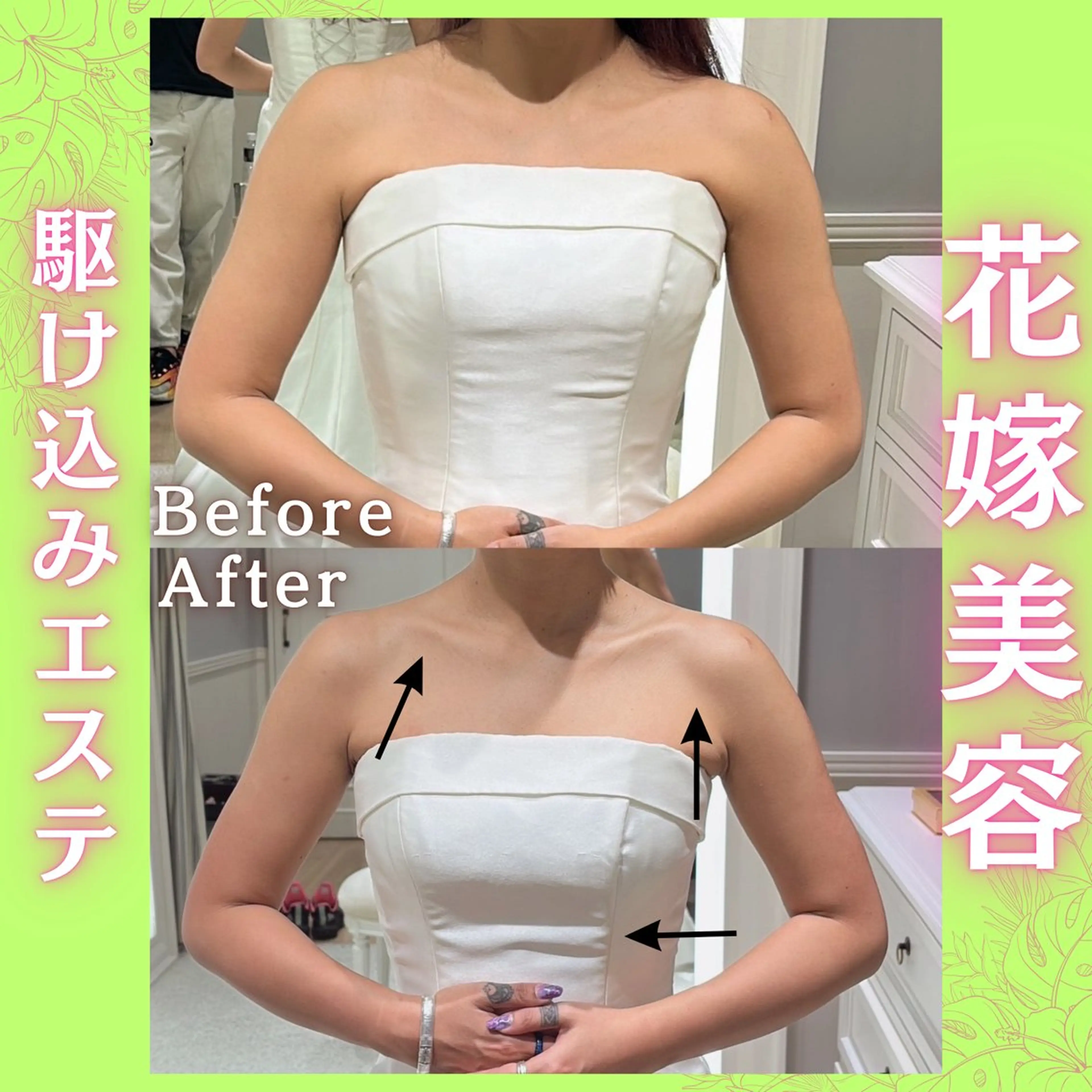 【ブライダル花嫁美容👰‍♀️】二の腕贅肉撃退！背中美人に✨の写真