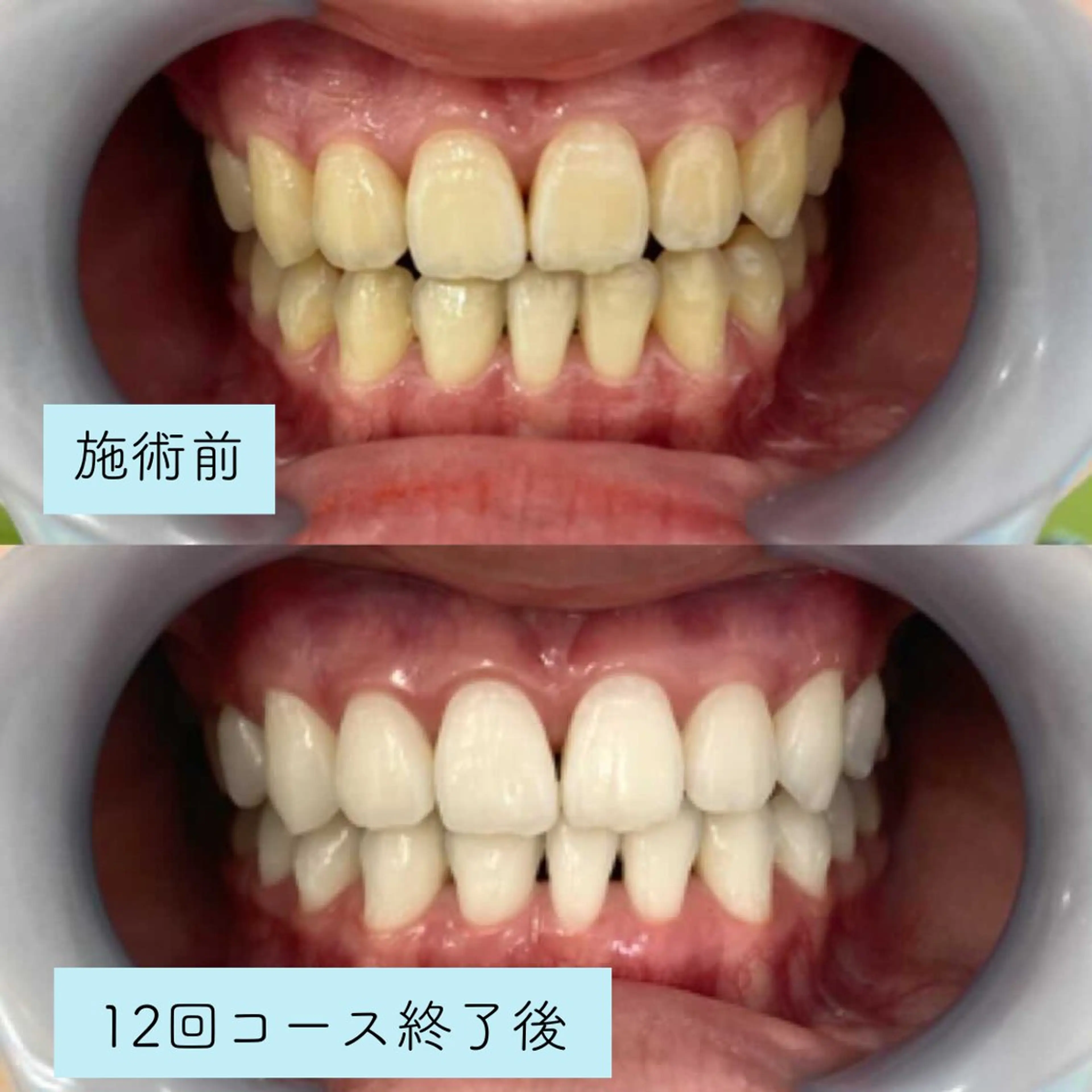 高性能セルフホワイトニング照射45分×1の写真