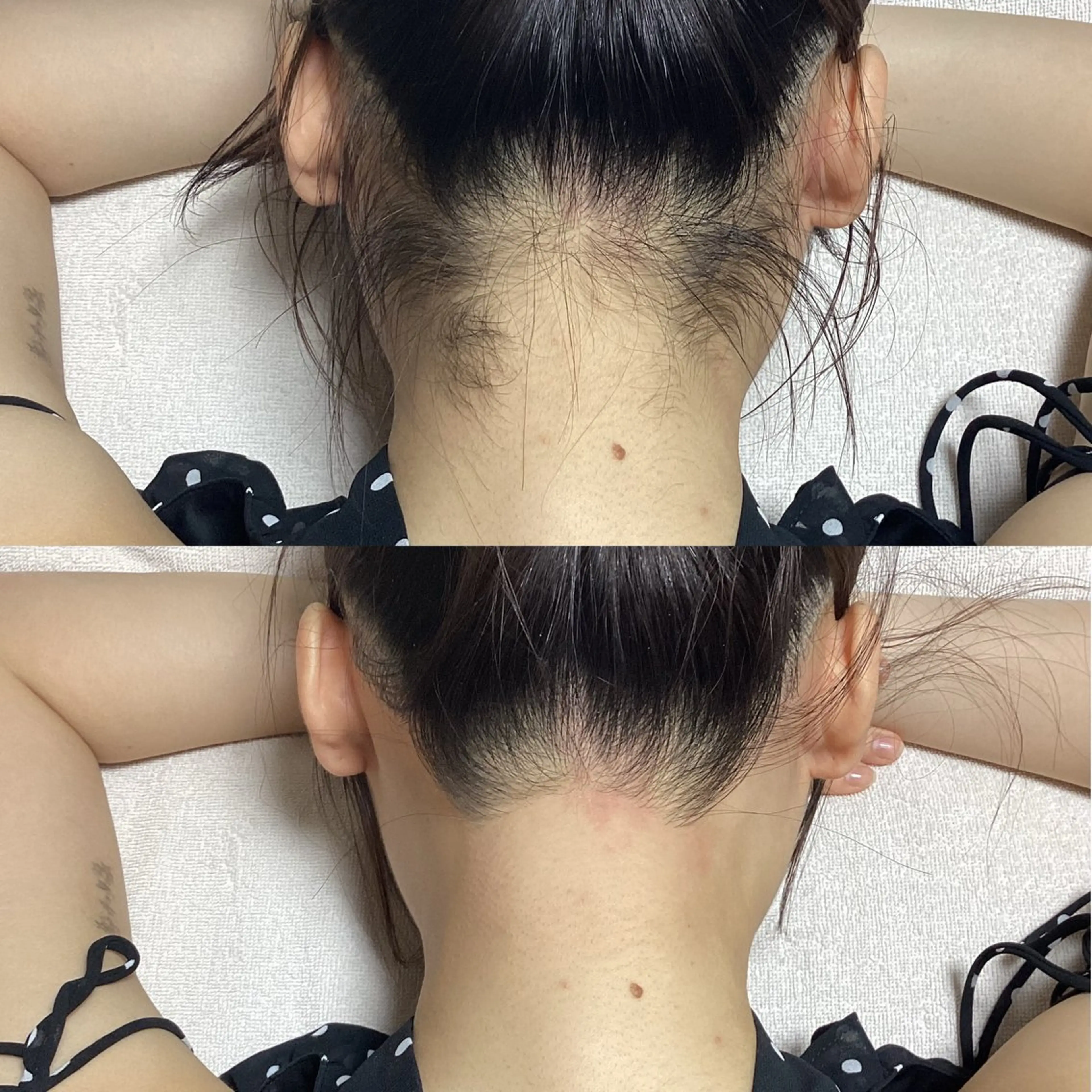 うなじ脱毛🌼で全方向美人！日頃の不快感・コンプレックスを解消🌱*・の写真