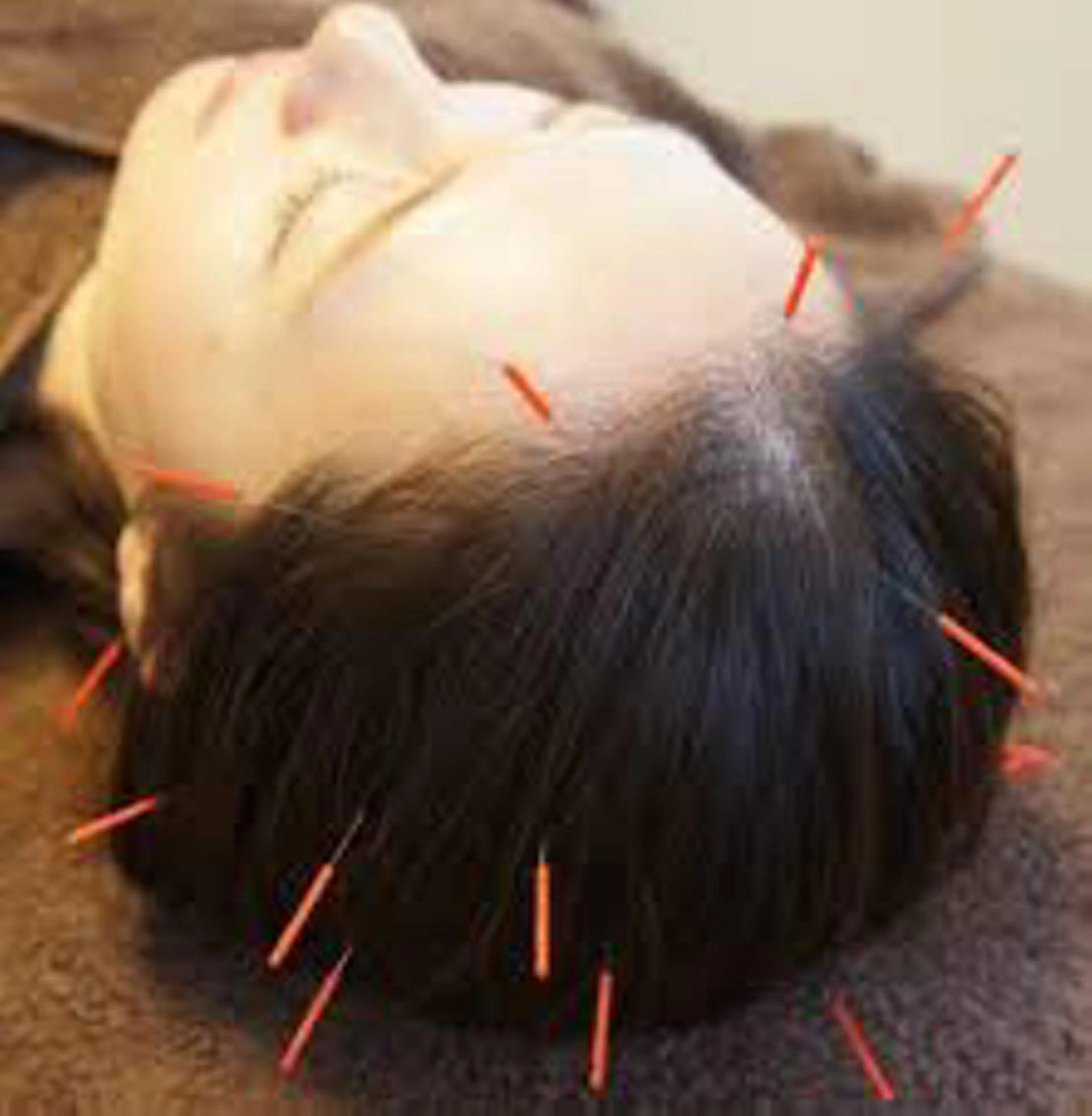 撮影モデル Acupuncture  salon LINOA リノア鍼灸院所属・ヘッドスパ鍼/小顔鍼 耳ツボ 　LINOAのエステ・リラクイメージ