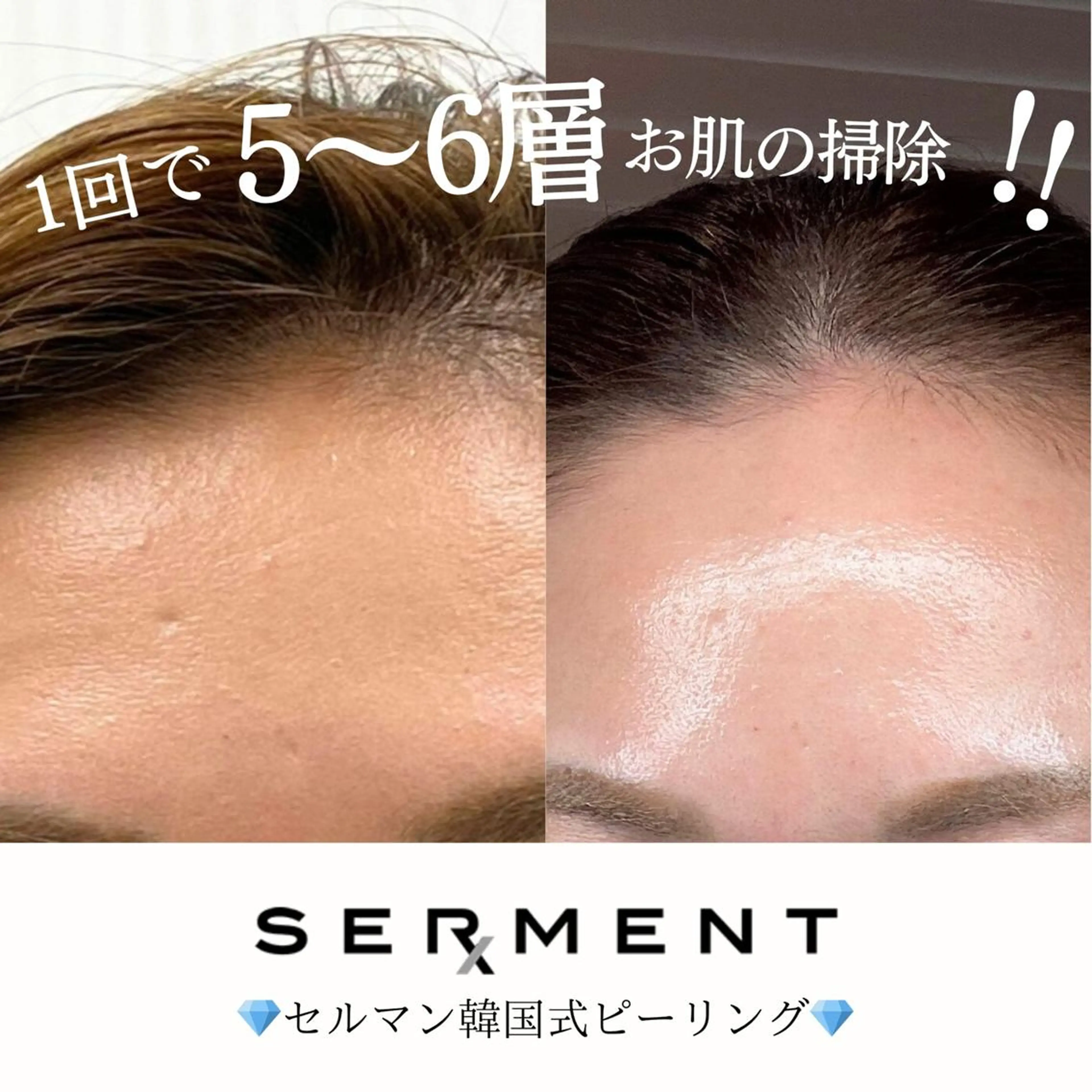💎SERMENT💎30代本格ケア(肌質改善)セルマン韓国ピーリング【体験】 ¥22,000→11,000の写真