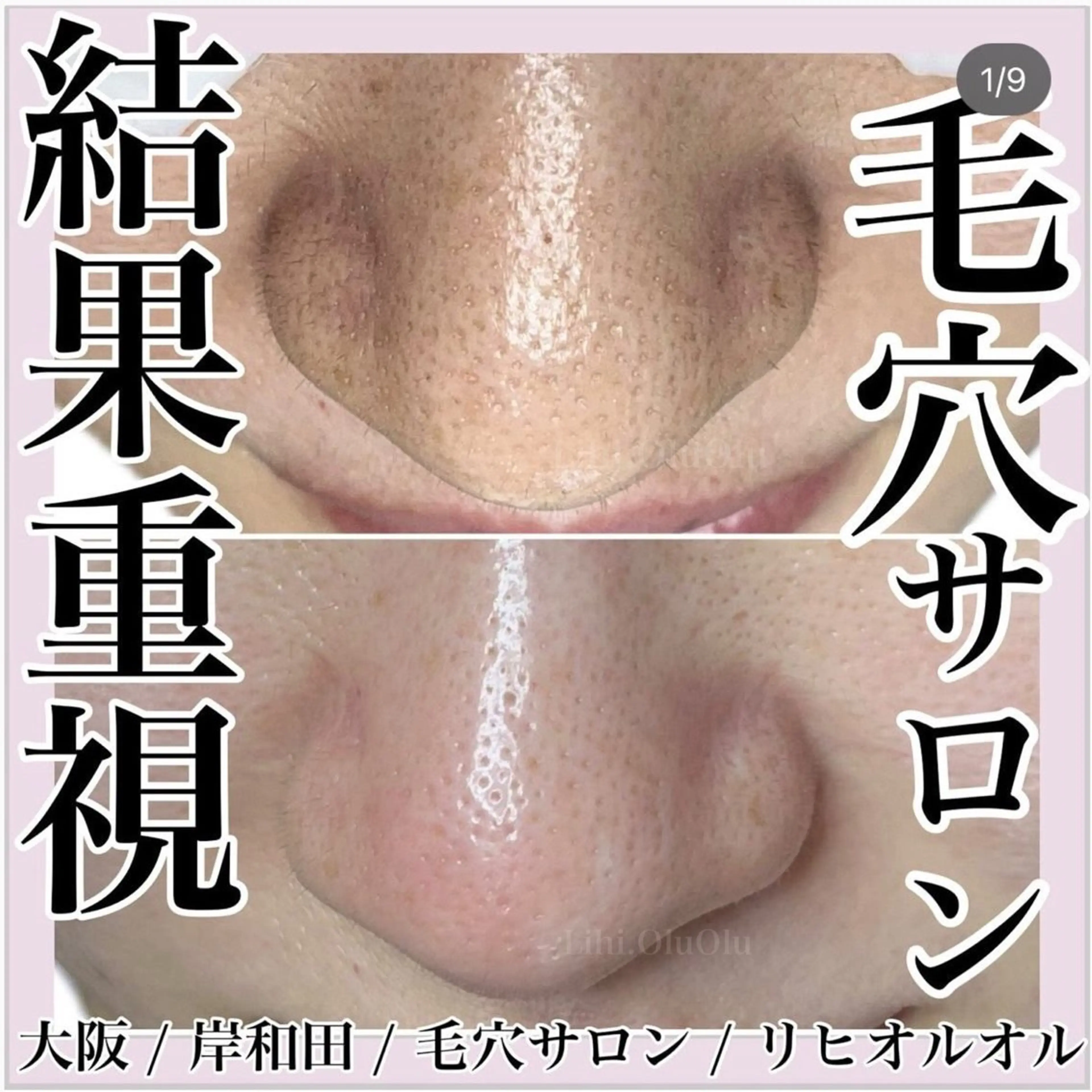 【新規】《毛穴美肌コース＋肌リセットWケア🌿‬》結果重視の毛穴洗浄❗️ずっと悩んできた毛穴・お肌わ変えたい！方に✨️の写真