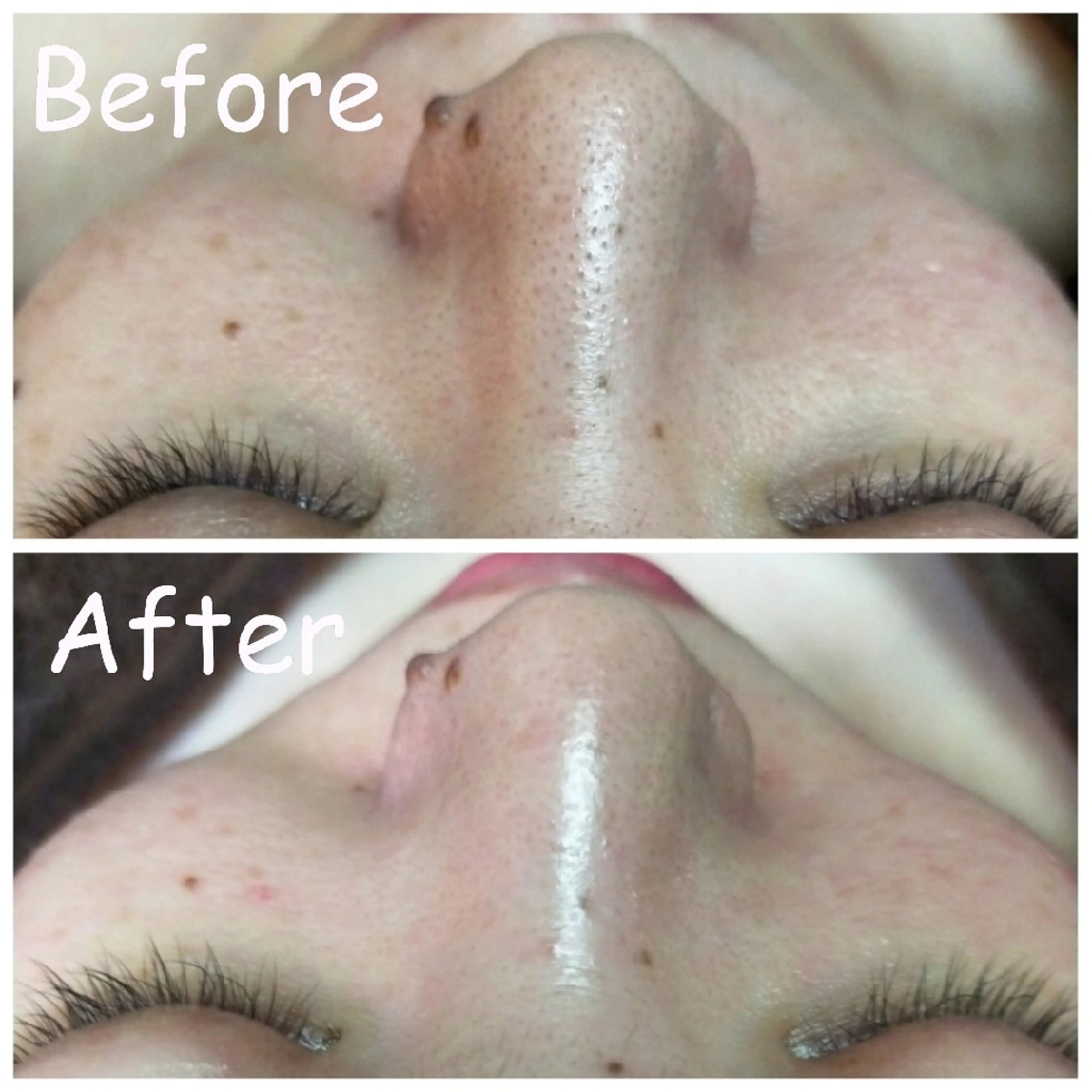 『 小顔＆毛穴集中フェイシャル 』フェイスラインと毛穴を同時に整える集中ケアの写真