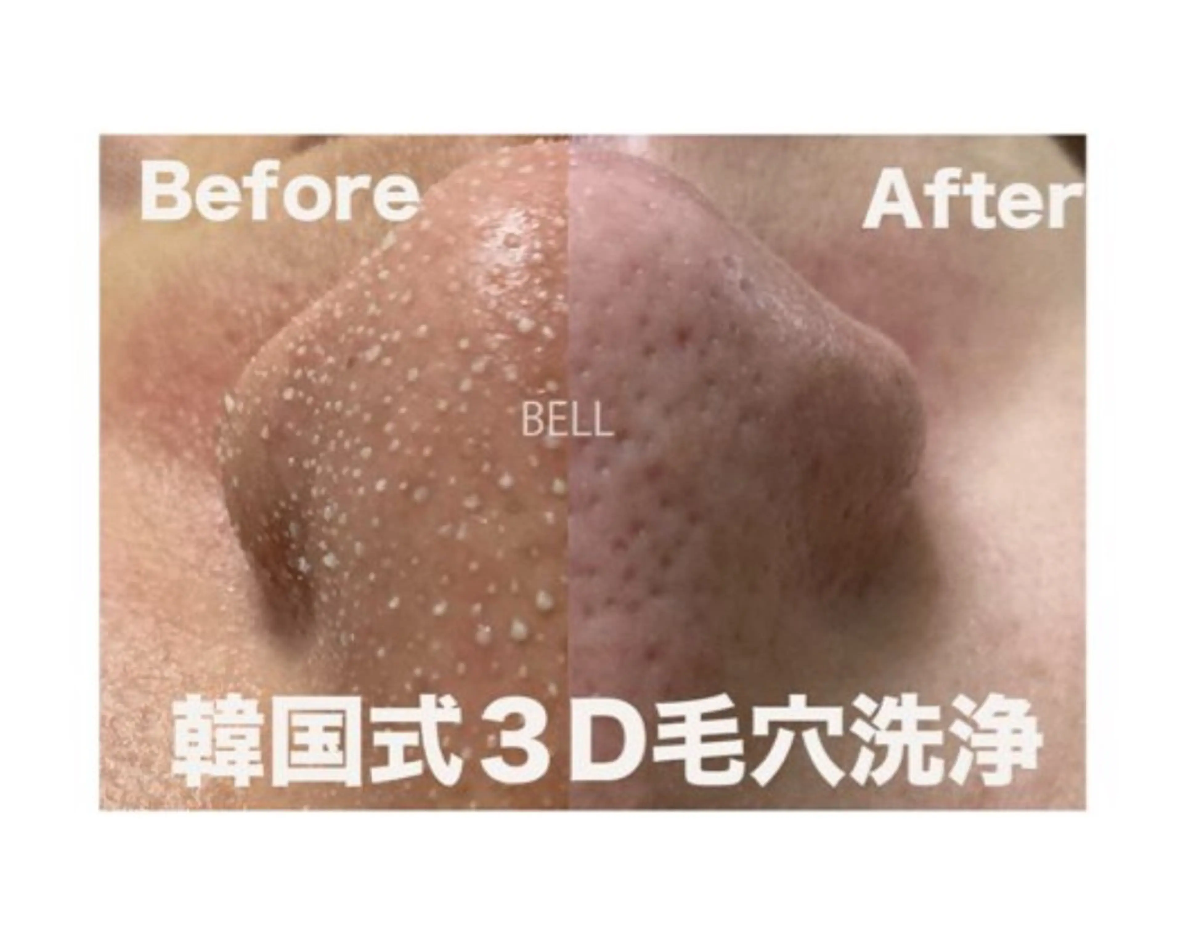 練習モデル募集🍀韓国式3D毛穴洗浄🇰🇷強い皮脂感や黒ずみ、頑固な毛穴汚れを撃退！メンズ◎人気No.1の全顔施術✨️の写真