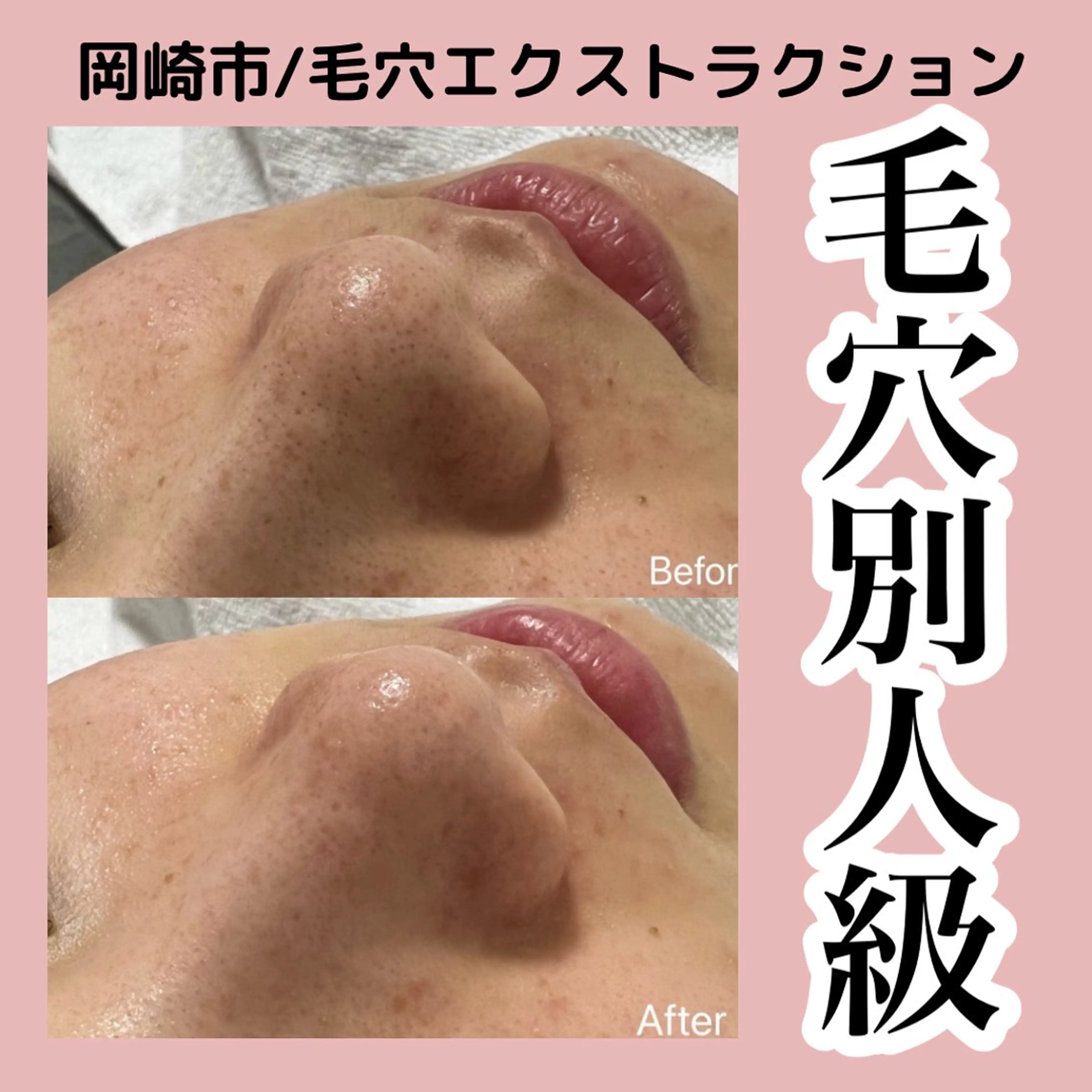 エステ ■超絶小顔＆肌管理室■所属・🦋整形級の究極美顔 本格韓国式小顔🦋のエステ・リラクイメージ