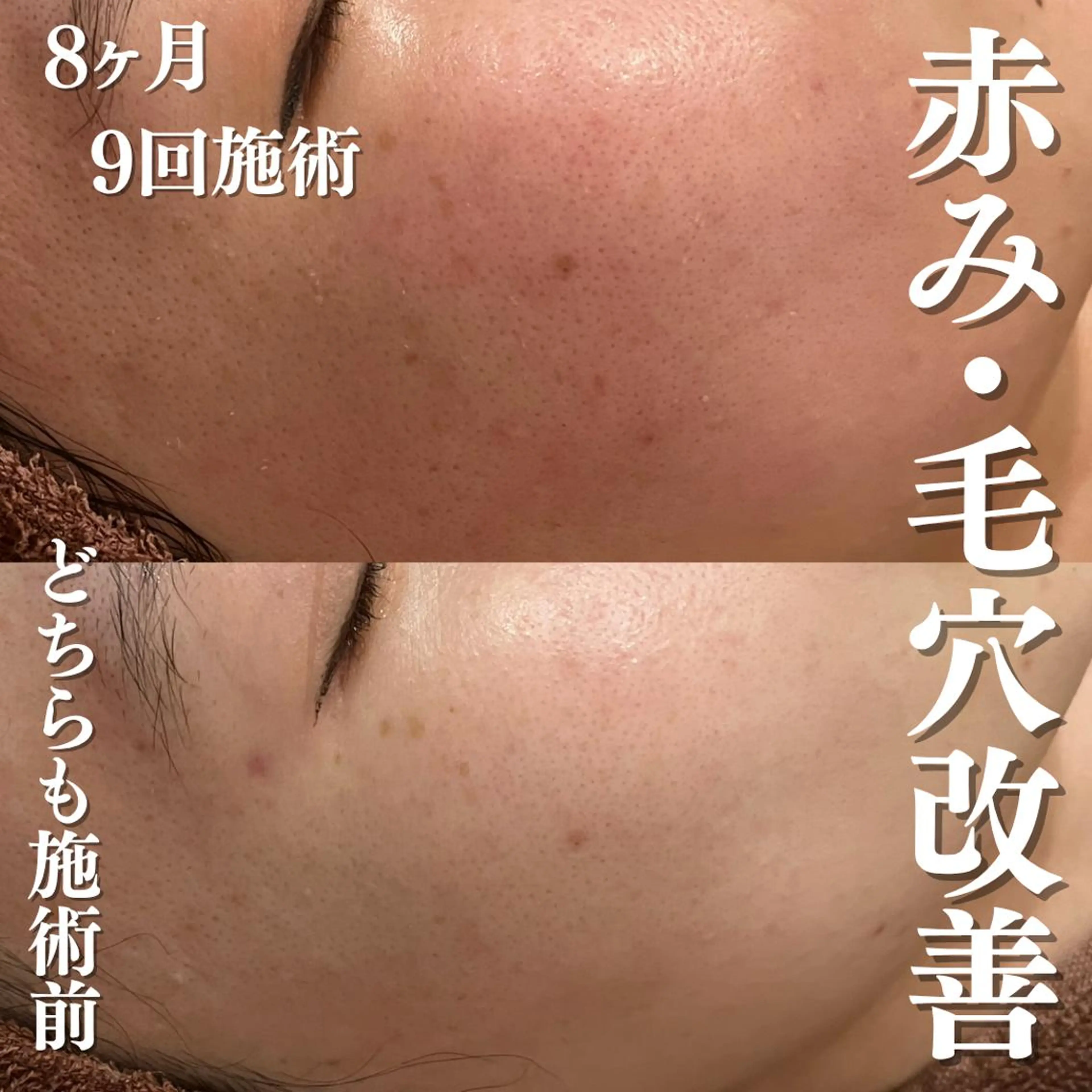 ニキビ特化型エステ 🍓最短で肌質改善のエステ・リラクイメージ