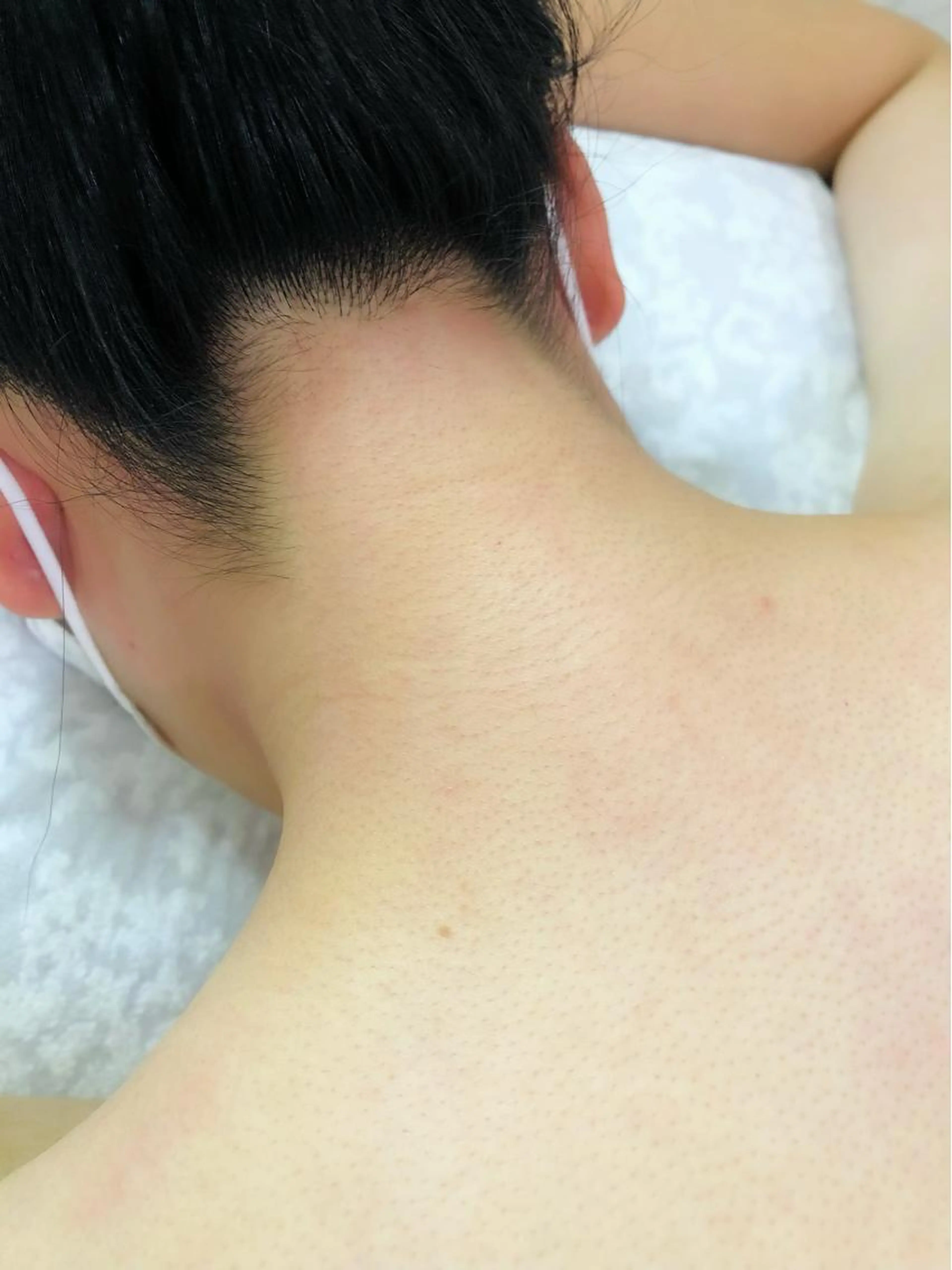 【ダブル脱毛】シュガーリング（うなじ）＋光脱毛（うなじ）の写真