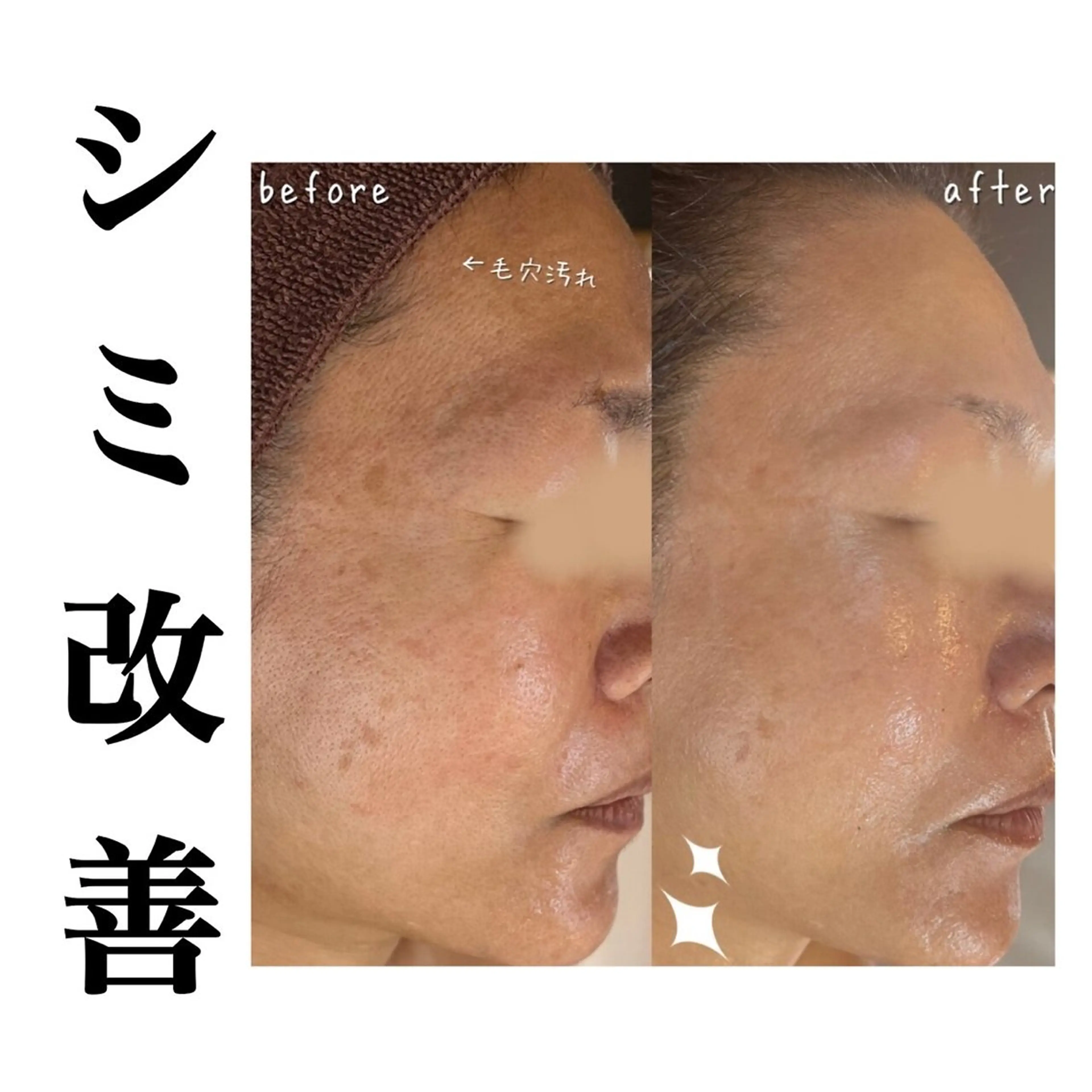 【ハーブピーリング/毛穴洗浄】NA skin 川崎店〜ニキビ・毛穴専門店〜所属・NAskin川崎 皆川のエステ・リラクイメージ
