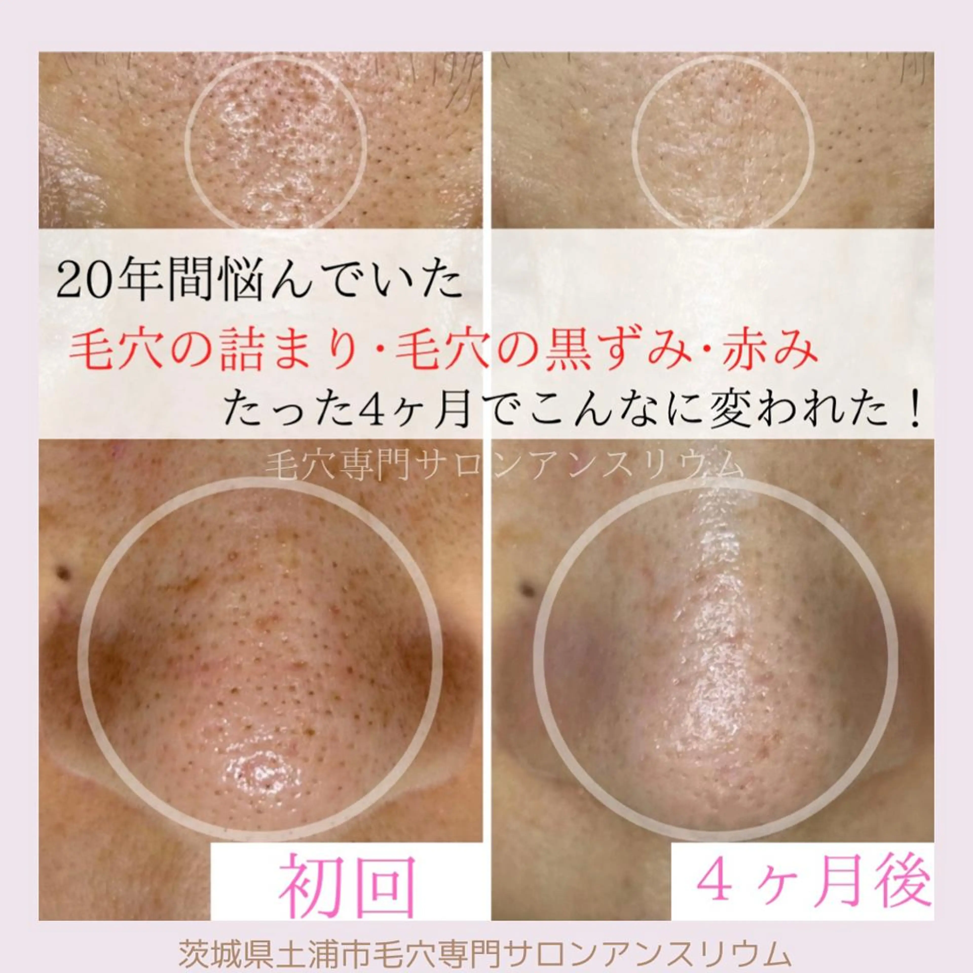 毛穴ケア専門サロンアンスリウム所属・茨城土浦 つくば毛穴 ケア専門サロンのエステ・リラクイメージ