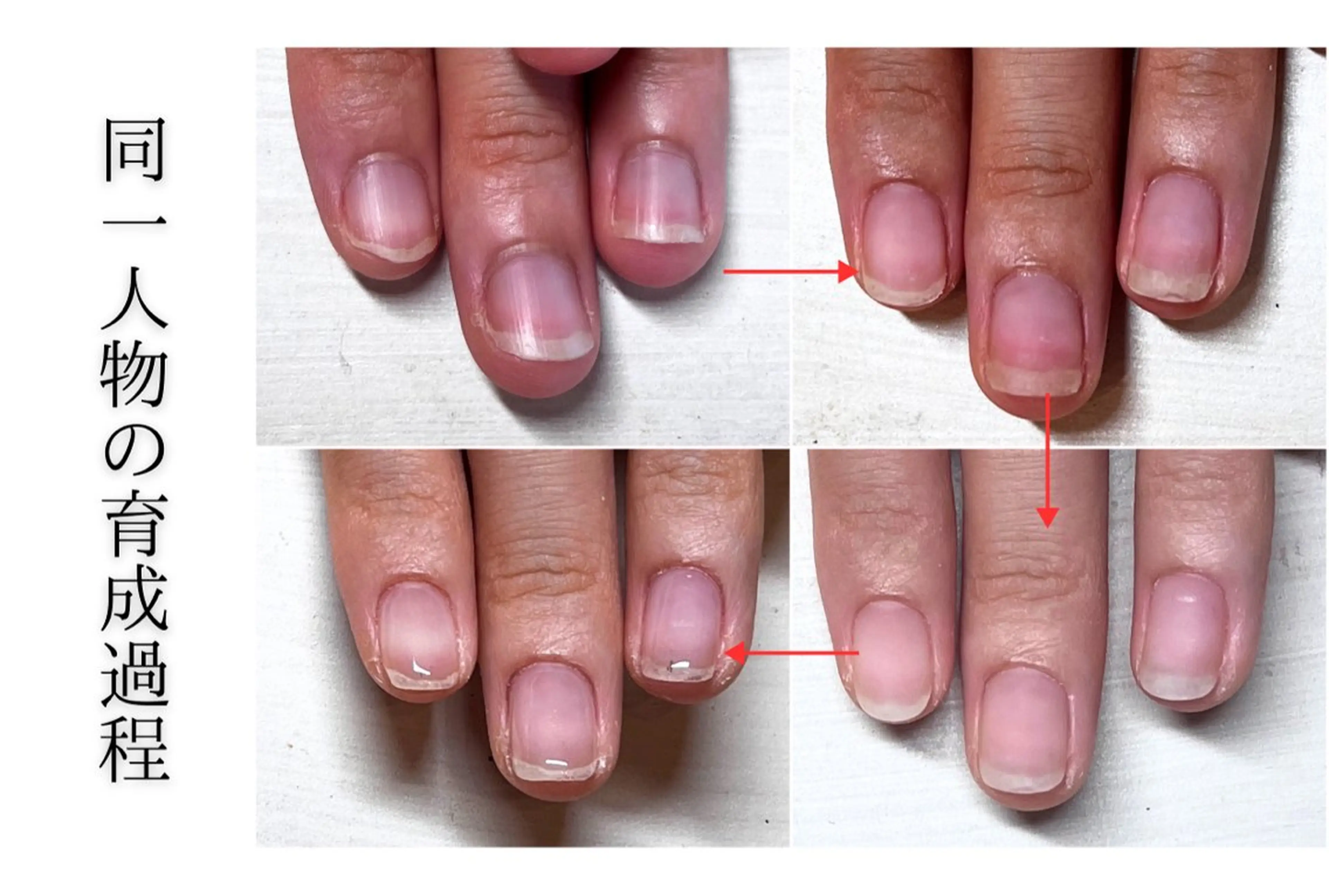 ネイル ピンク 深爪矯正・自爪育成 ヴェールリムのネイルデザイン