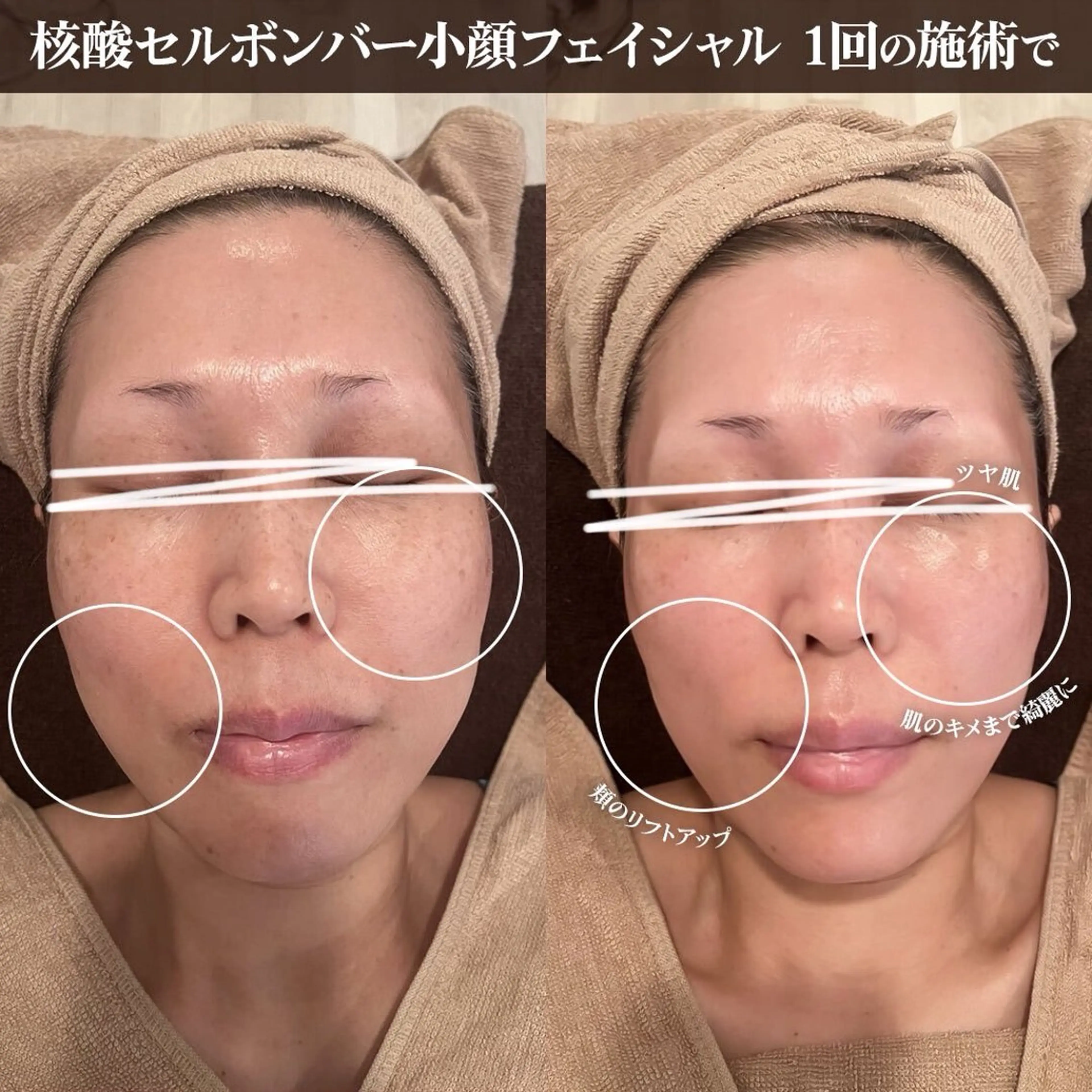 【DNA美容】内側からふっくら✨艶肌リフトアップフェイシャル　核酸セルボンバークリーム使用(60分)の写真