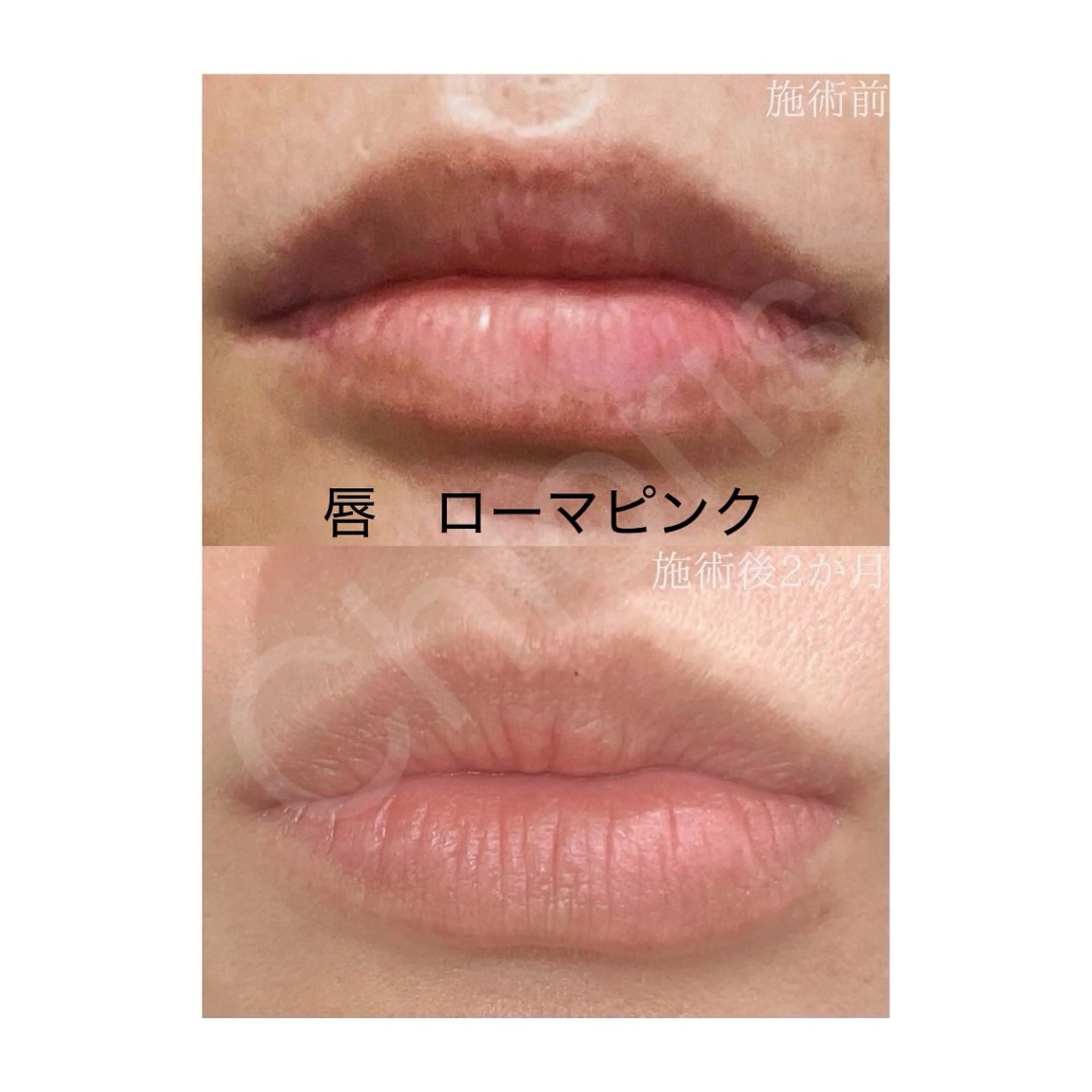 川越ローマピンク 光脱毛＆ワックス脱毛のエステ・リラクイメージ