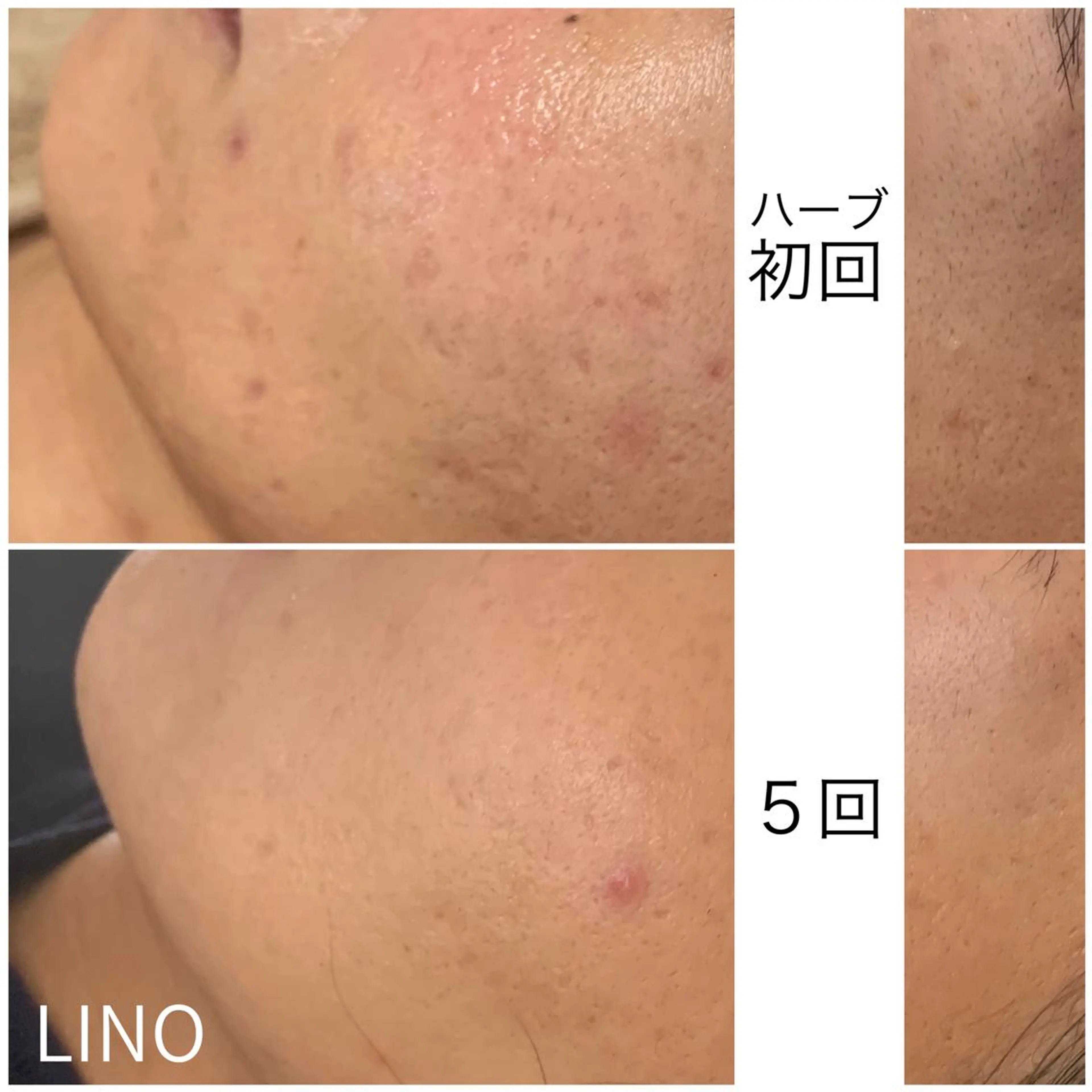 beautysalon  LINO所属・7月限定【平日限定】 全メニュ¥4,400のエステ・リラクイメージ