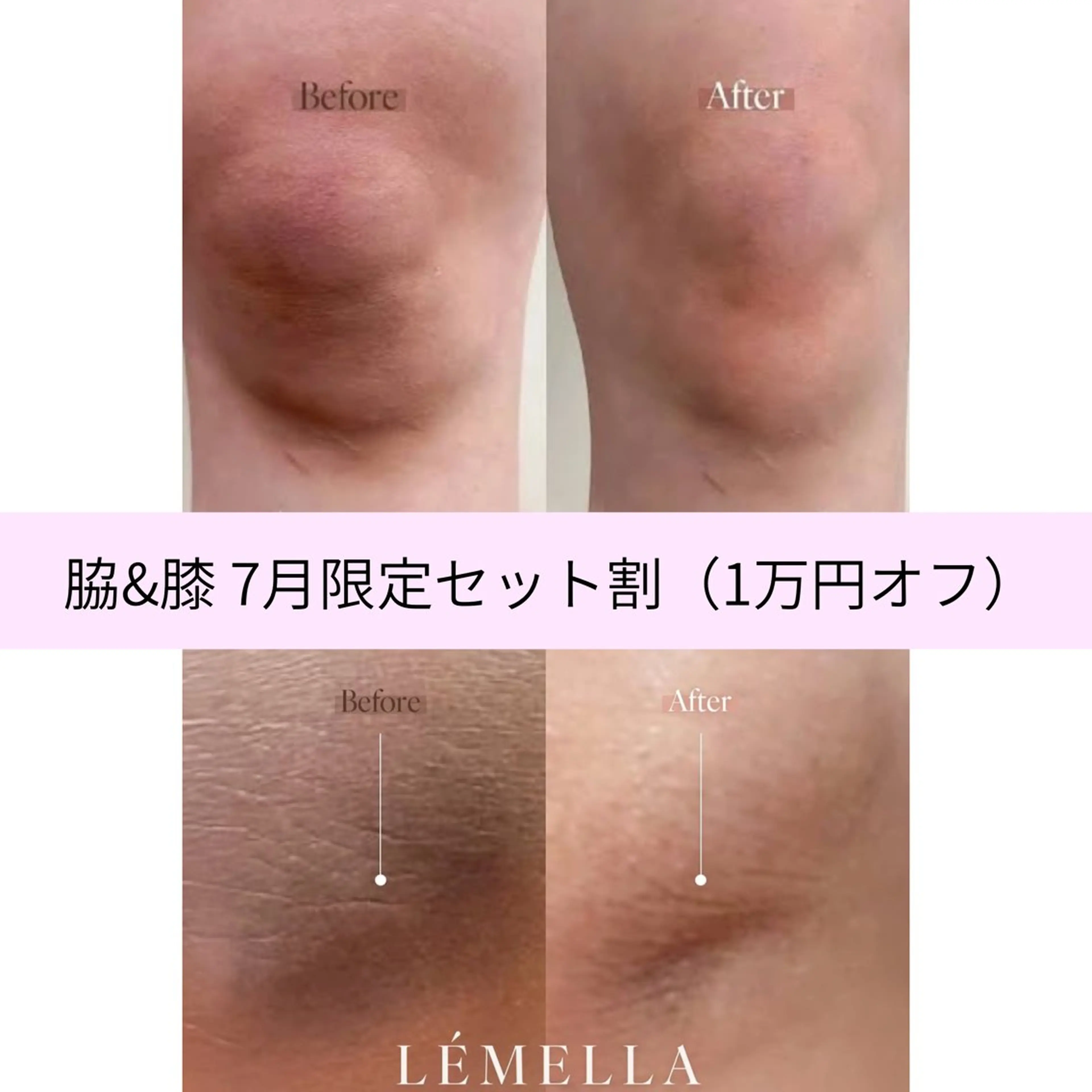 📍《7月限定》脇・膝セット割 🏝夏前美肌セット🏝ルメラ/メラニンケアの写真