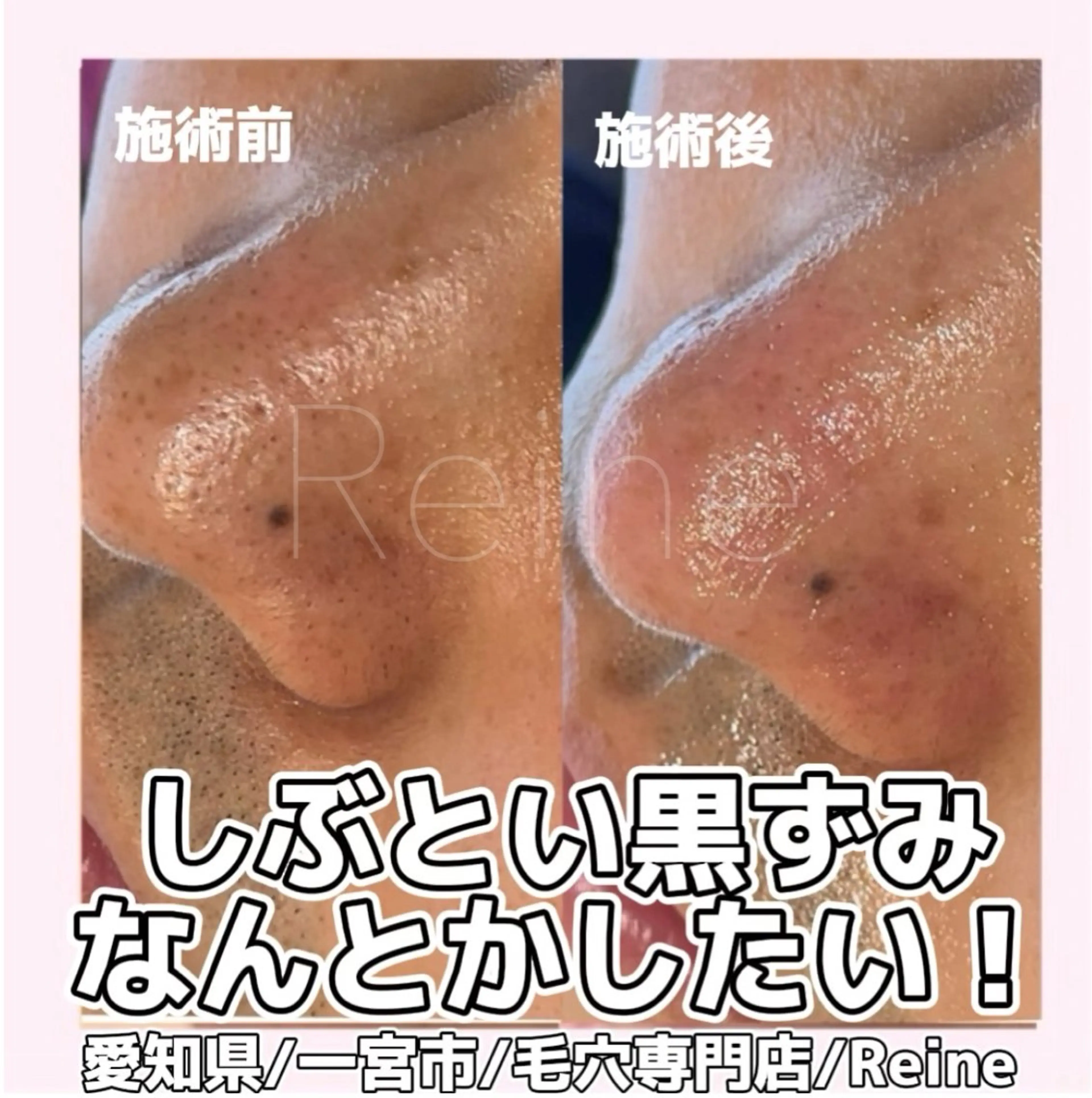 エステ Reine BeautySalon所属・毛穴/シミ肝斑/脱毛 横山梨里のエステ・リラクイメージ