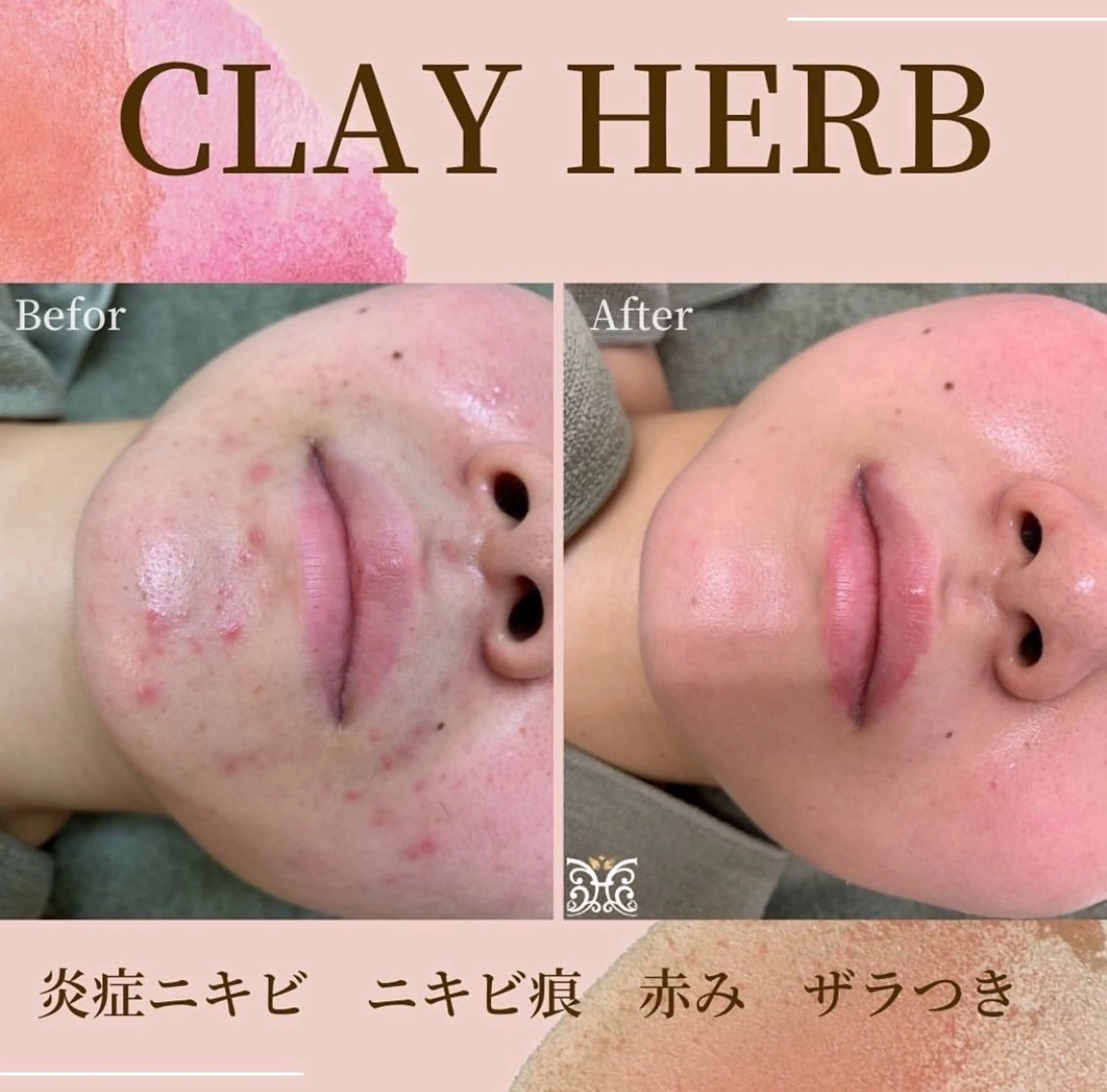 OPEN記念人気NO1【剥離ありハーブピーリング/レベル3】ハーブ量3倍の写真