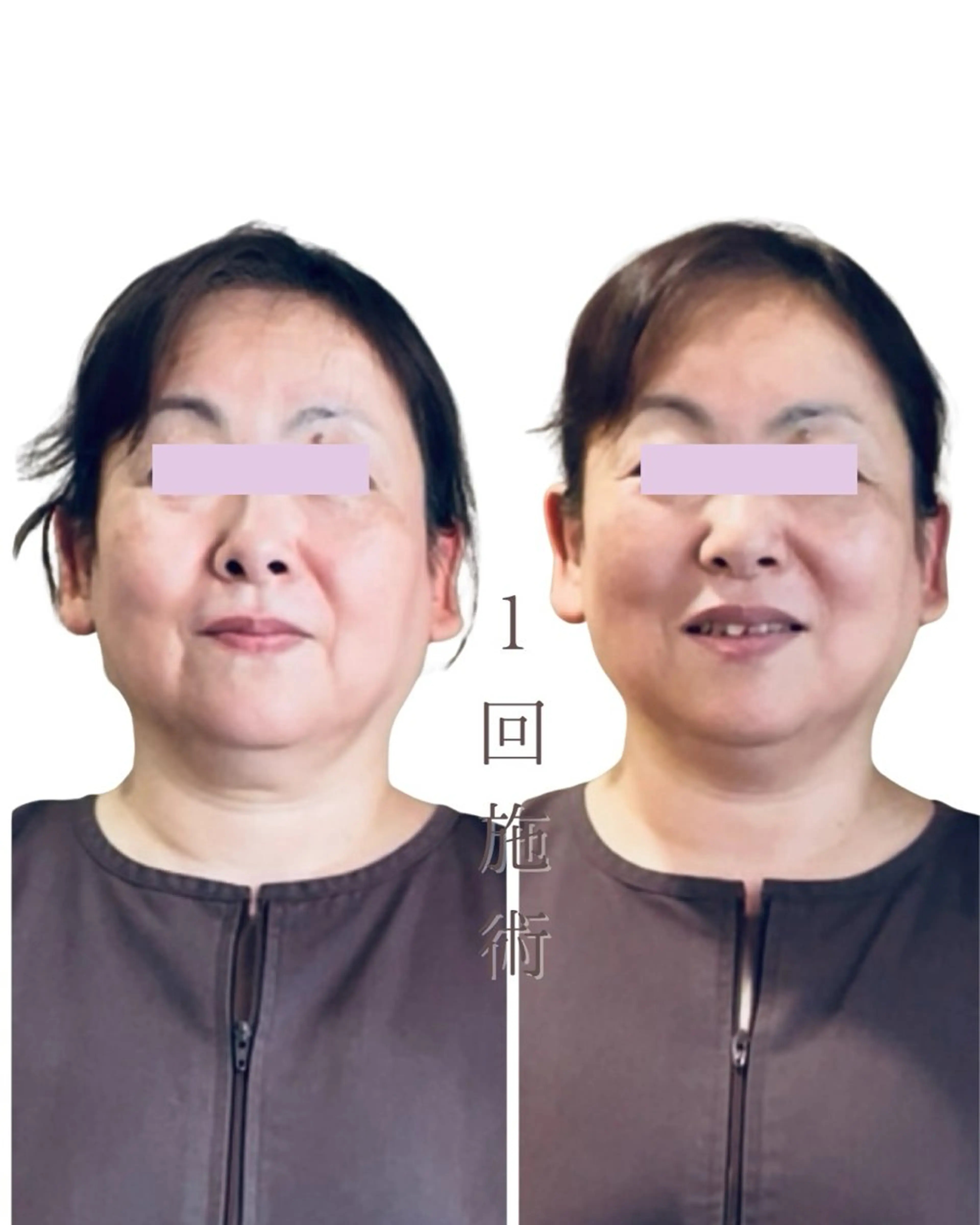 麻布十番/圧倒的小顔 🐷毒だし美容鍼灸のエステ・リラクイメージ