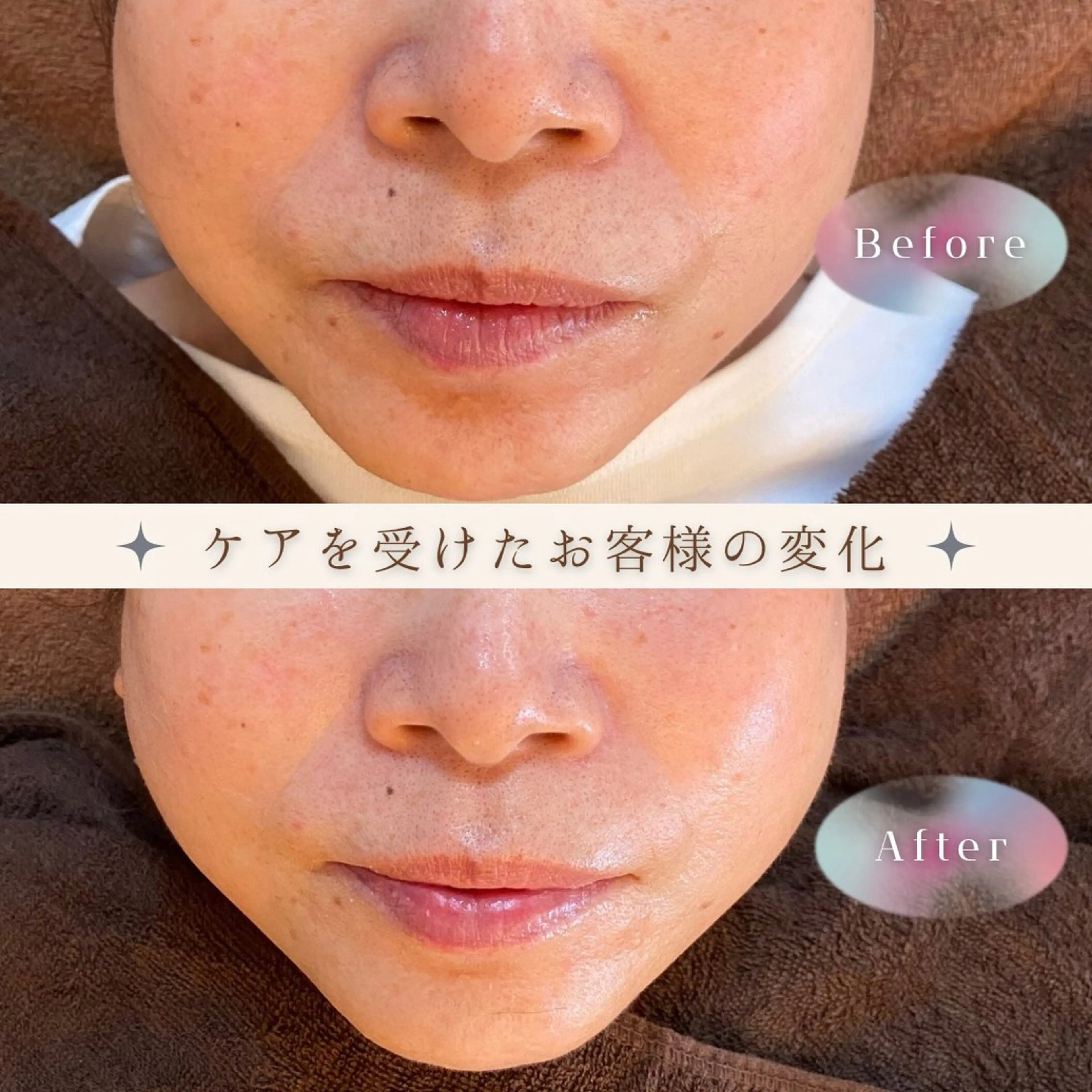 リセルシュールトリートメント🥰艶、毛穴、シミ、リフトアップ😘美容機器で全てのお悩みにダイレクトにアプローチ🫶の写真