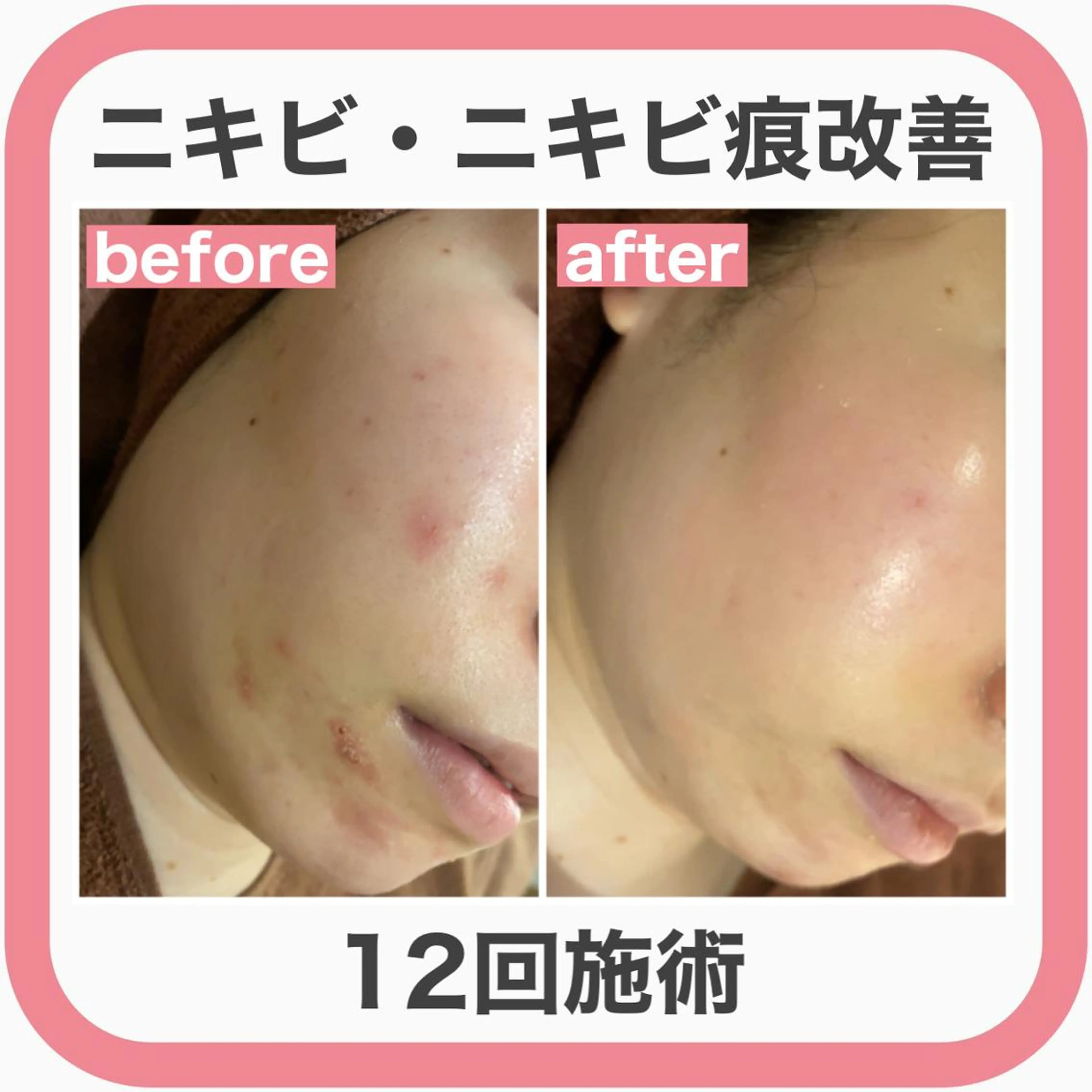 皮膚科より効果あり ⁉️最短ニキビ改善のエステ・リラクイメージ