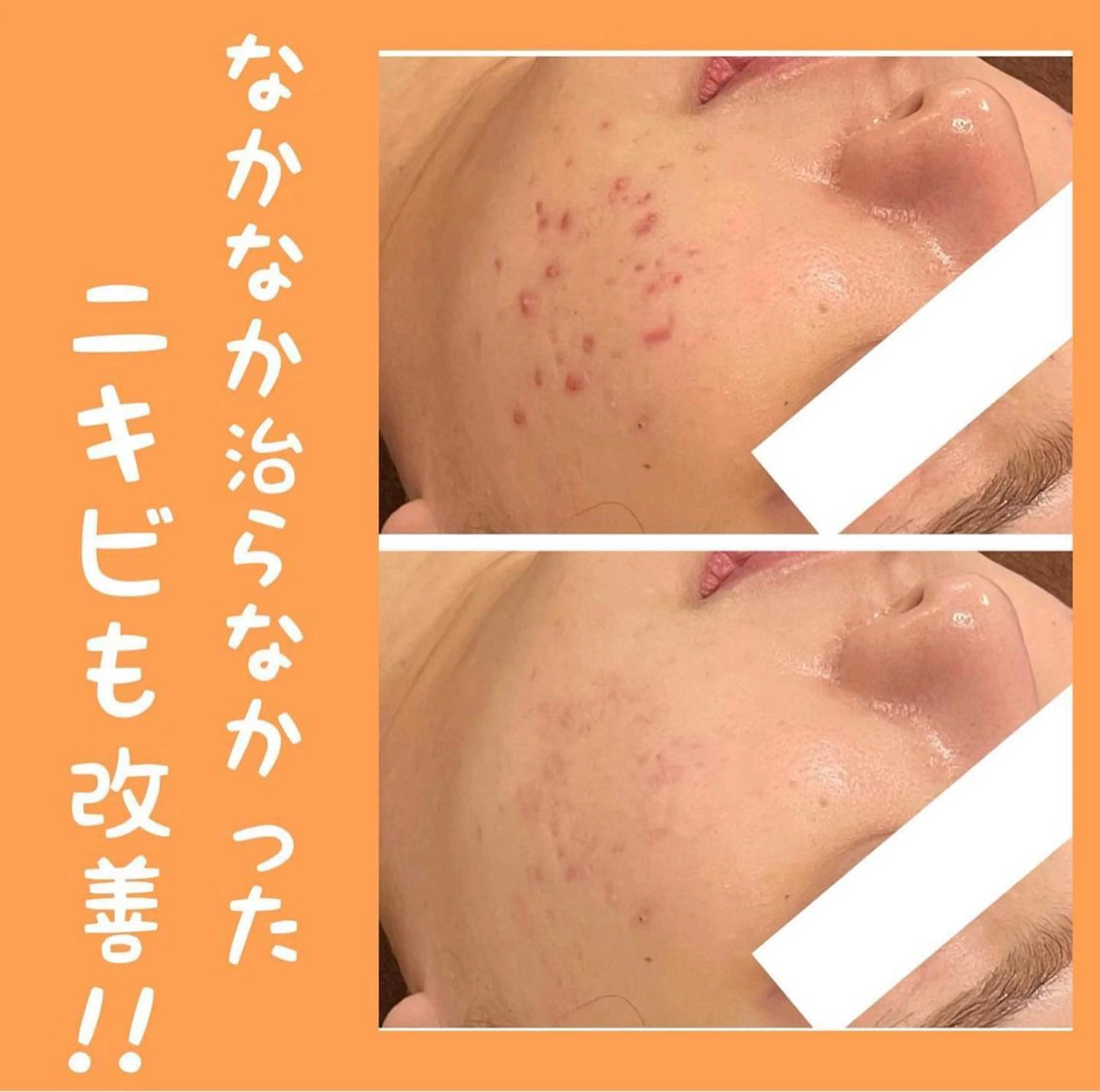 エステ Meow！～トラブル肌専門ピーリング＆脱毛サロン～所属・トラブル肌改善🏥 Meow！🫧🫧のエステ・リラクイメージ