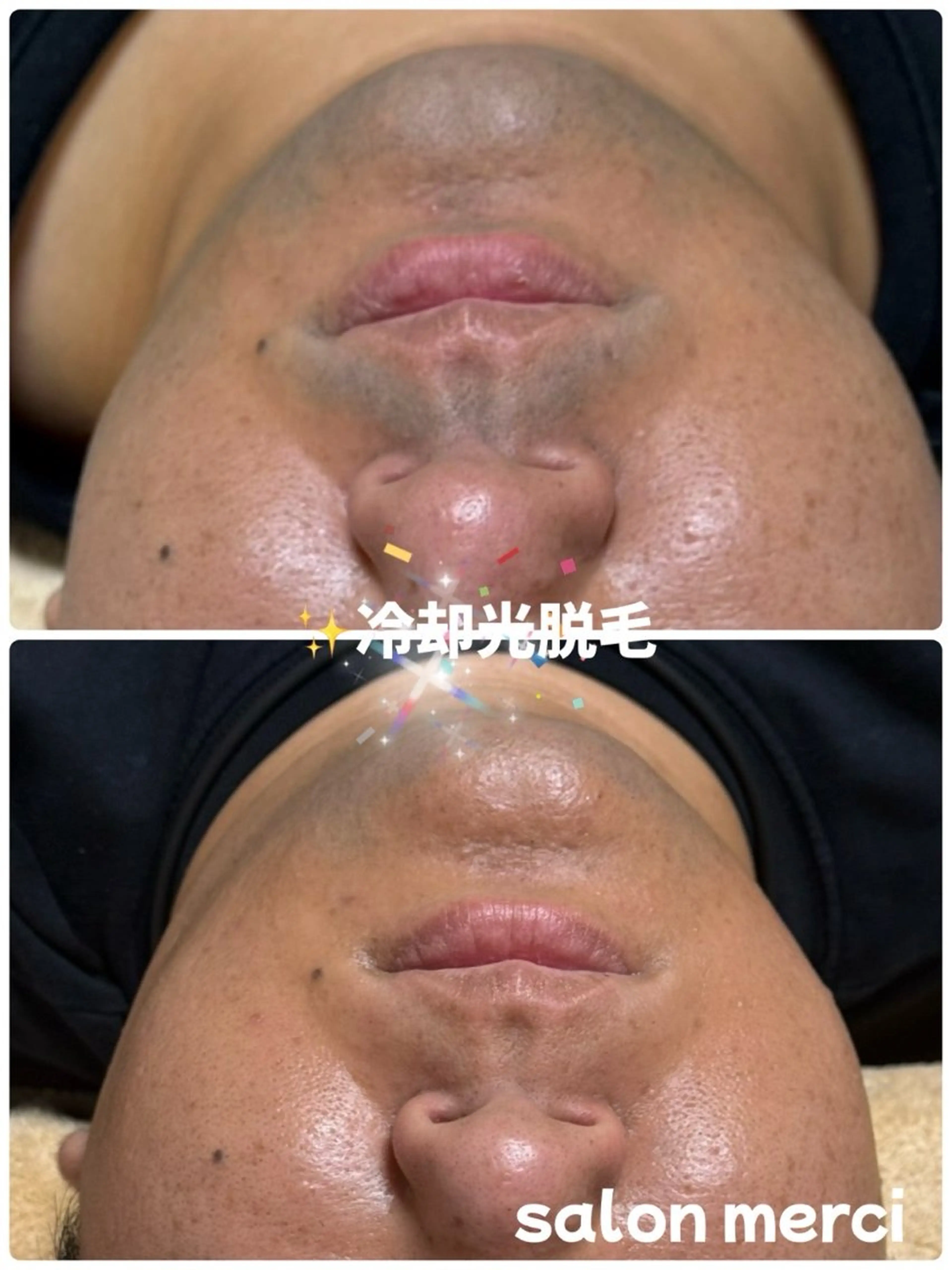 メンズ髭脱毛の写真