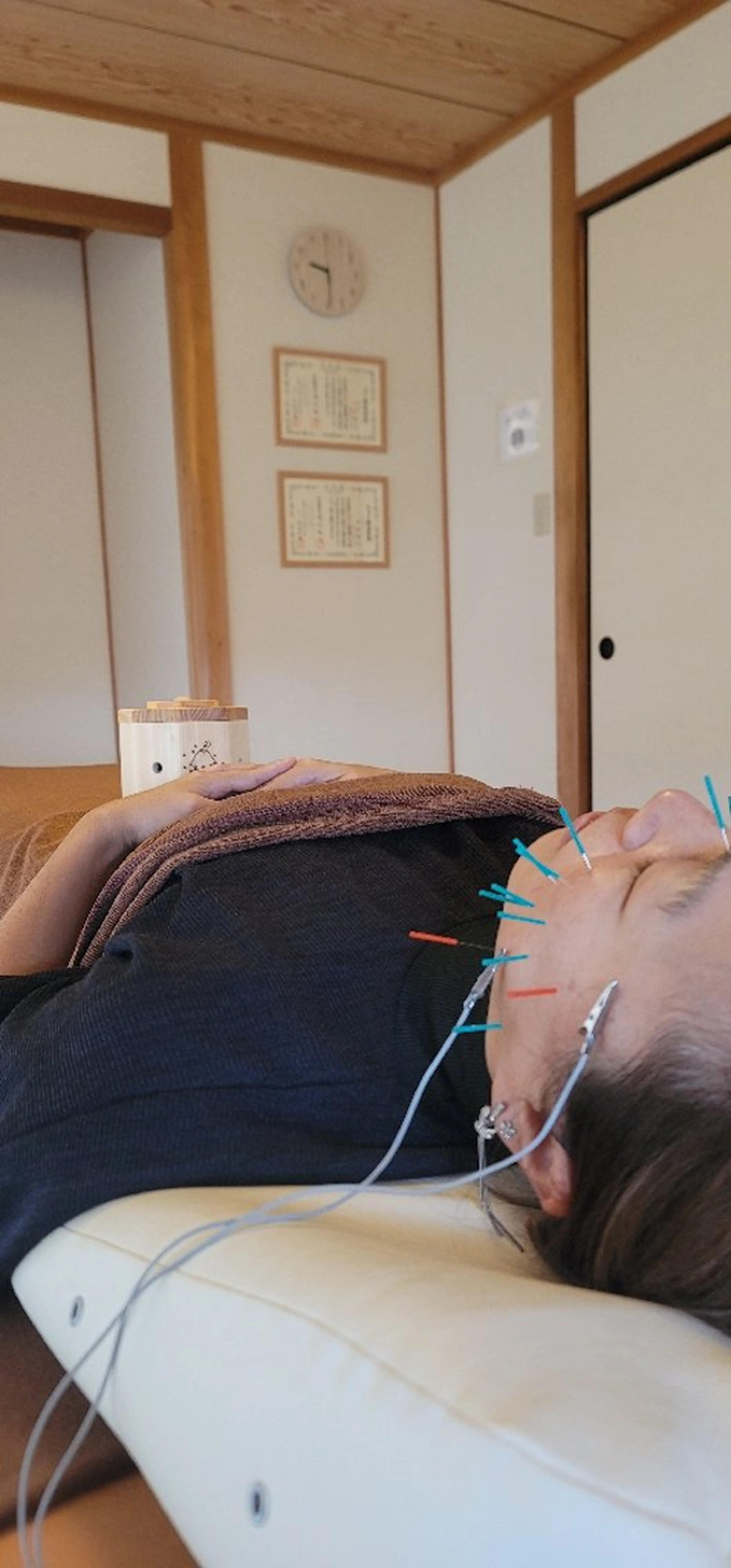 [眼精疲労・エラの張り特化]初回美容鍼(ヘッドスパ付き)の写真