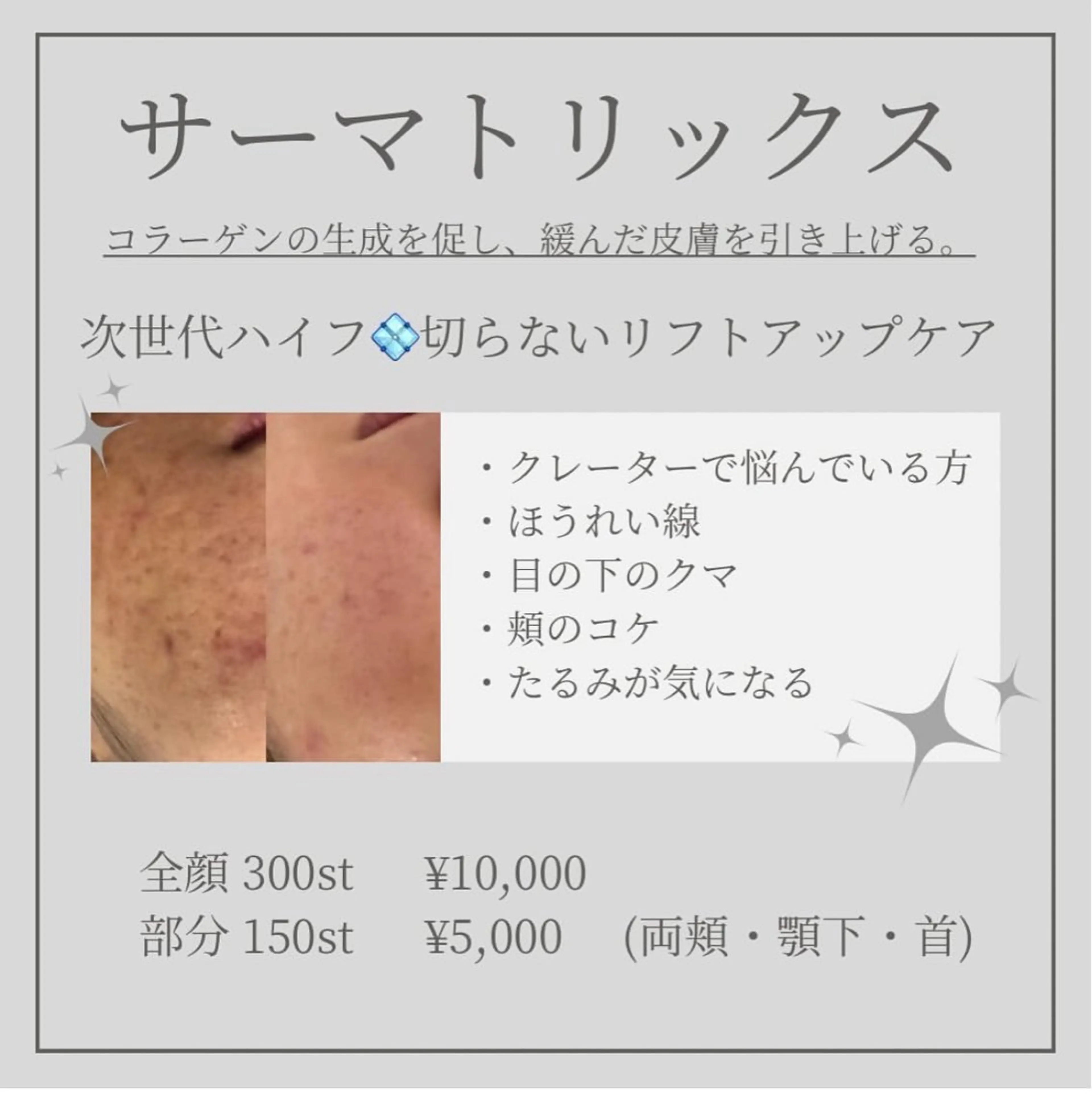サーマトリックス🤍全顔300shotの写真