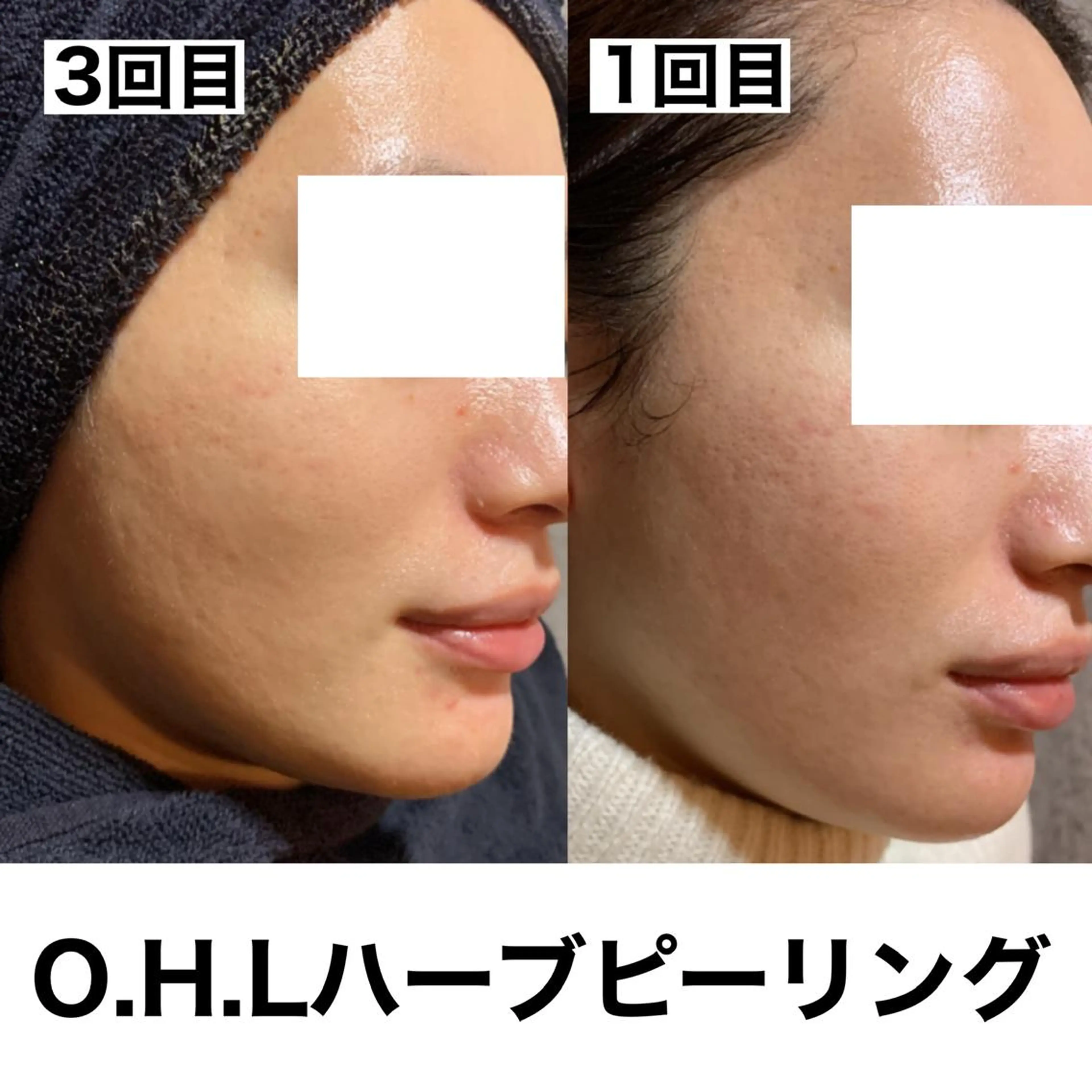 姫路ハーブピーリング・韓国肌管理専門店Emotional所属・Yuka .のエステ・リラクイメージ