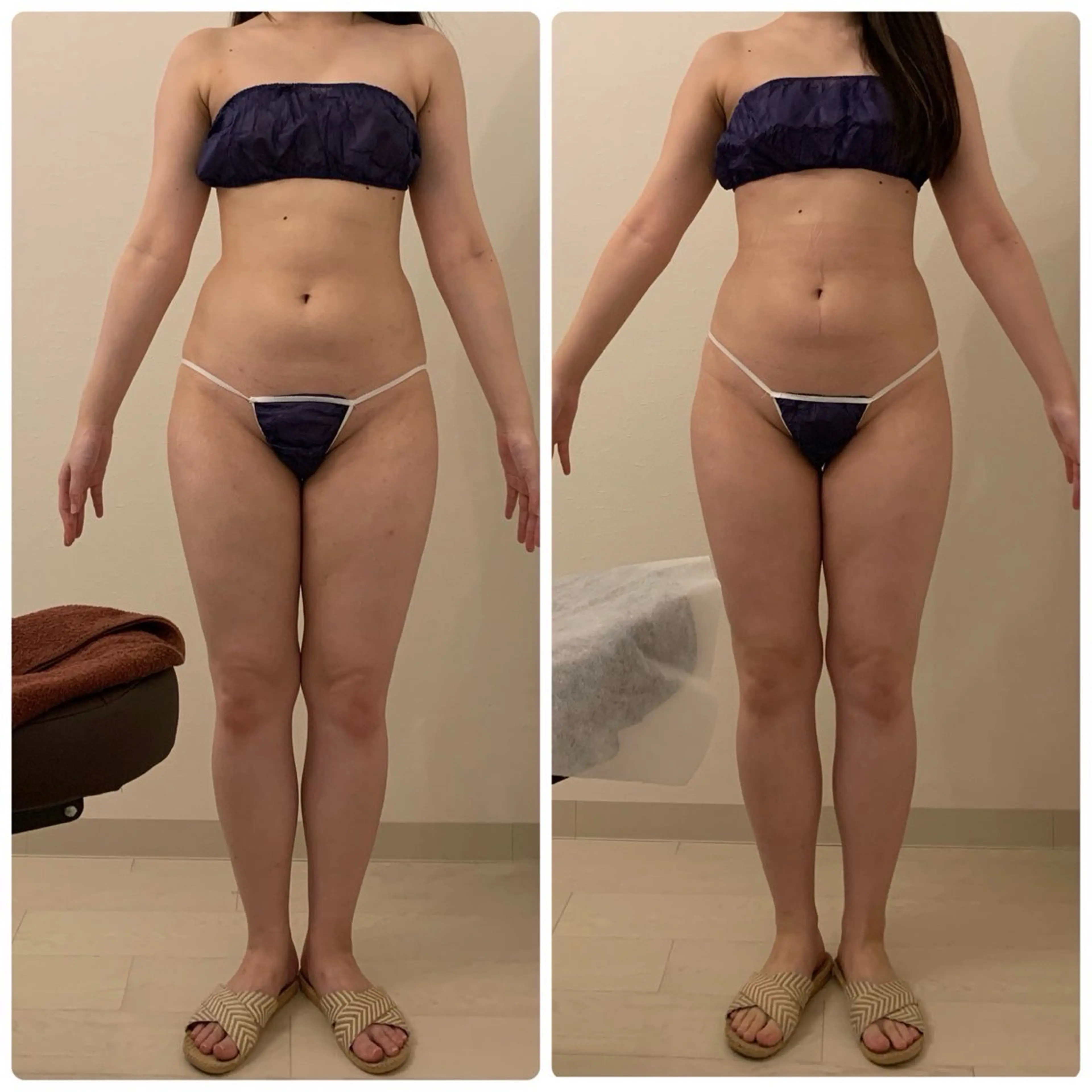 セルライトゼロ2/1年使用