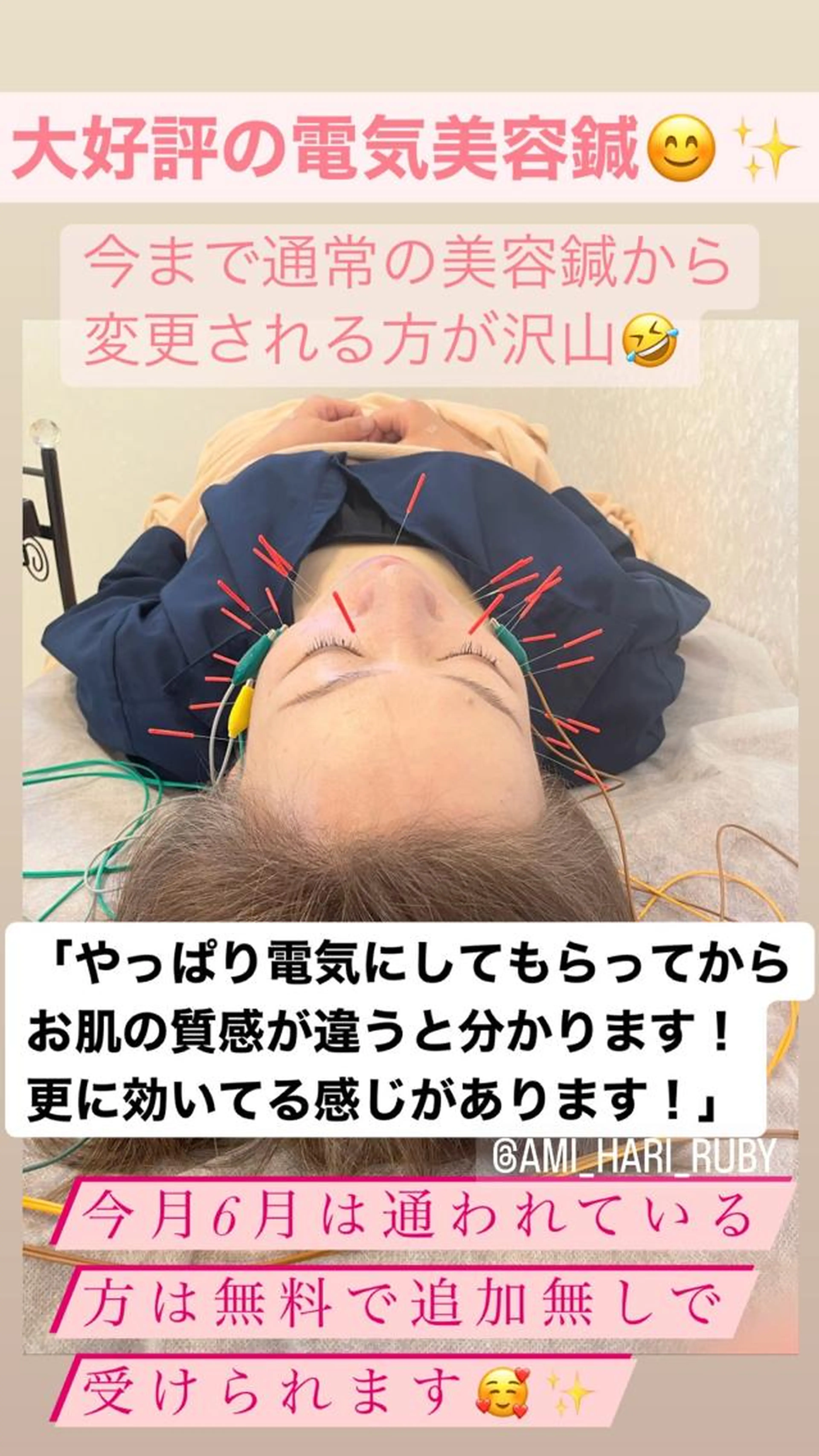 【即効リフトアップ‼️小顔電気美容鍼】(頭皮鍼＋美顔鍼＋EMS高周波+肩ほぐし＋ヒト幹細胞培養液導入)の写真